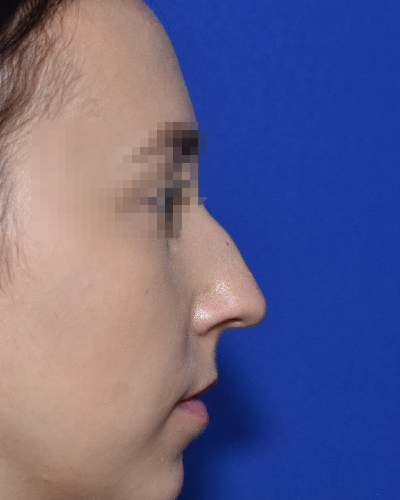 Rhinoplasty before, profile view — Case 90033, 25 Years