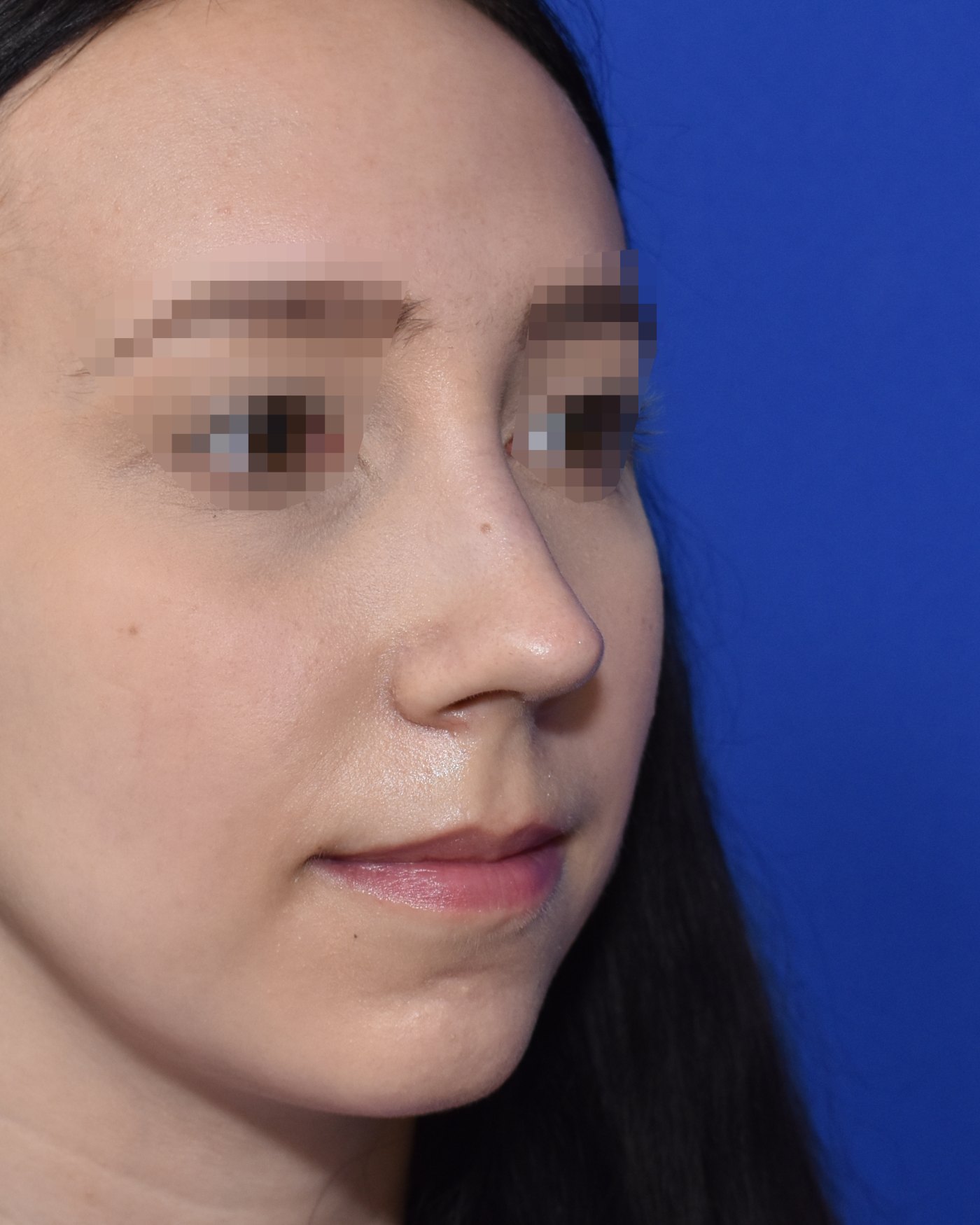 Rhinoplasty after, three-quarter view (45°) — Case 90033, 25 Years