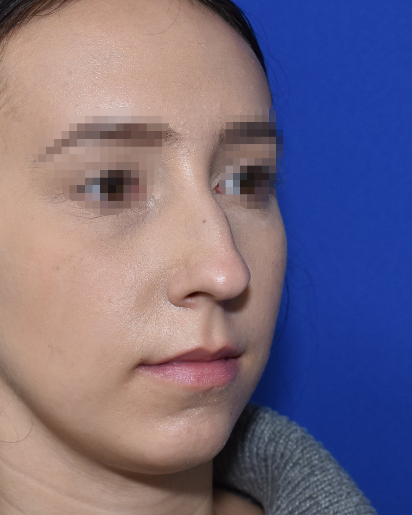 Rhinoplasty before, three-quarter view (45°) — Case 90033, 25 Years