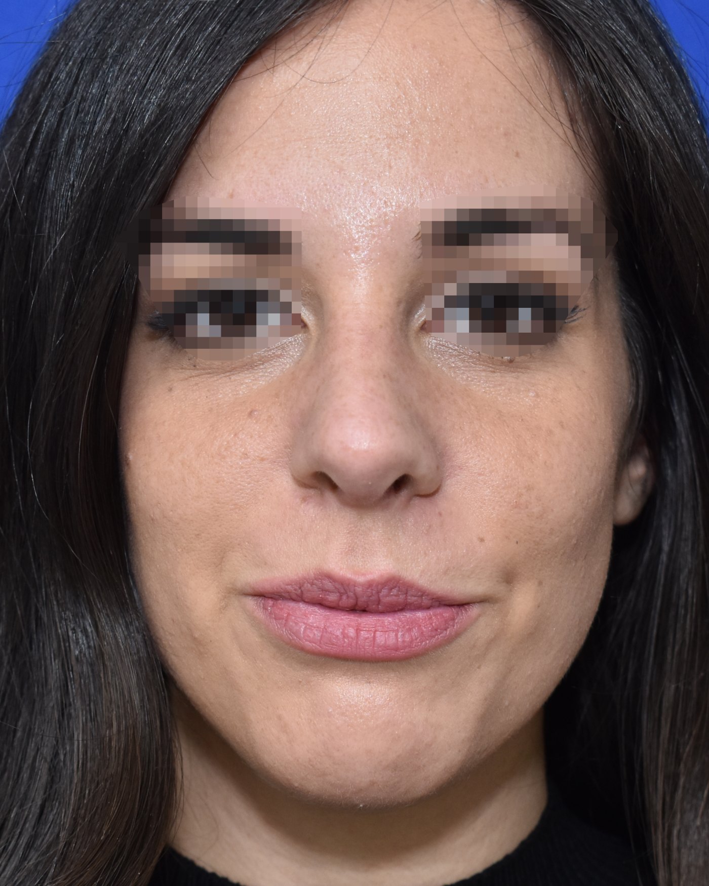Rhinoplasty after, frontal view: Dorsal hump, Oversized nose — Case 90034, 28 Years