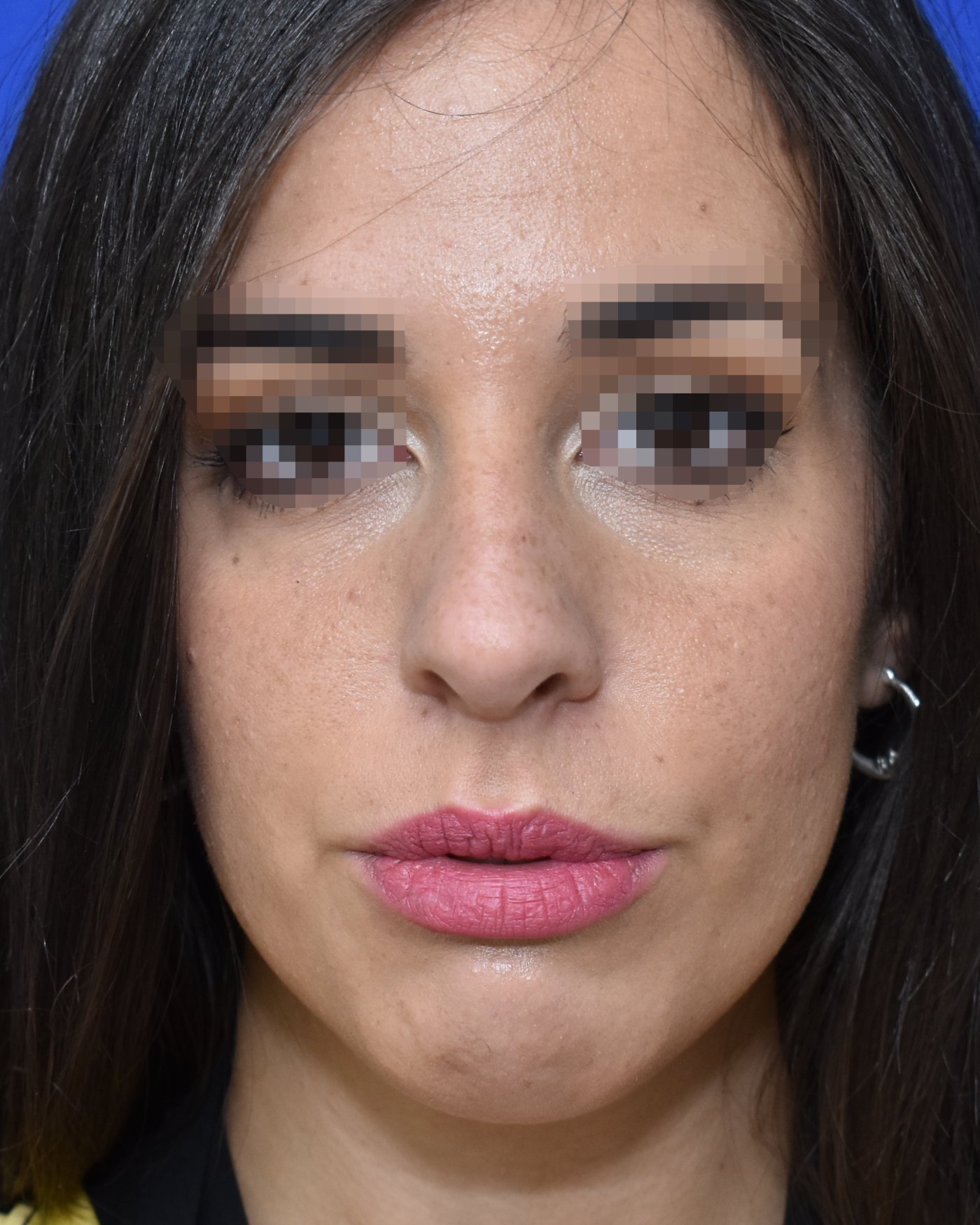 Rhinoplasty before, frontal view: Dorsal hump, Oversized nose — Case 90034, 28 Years