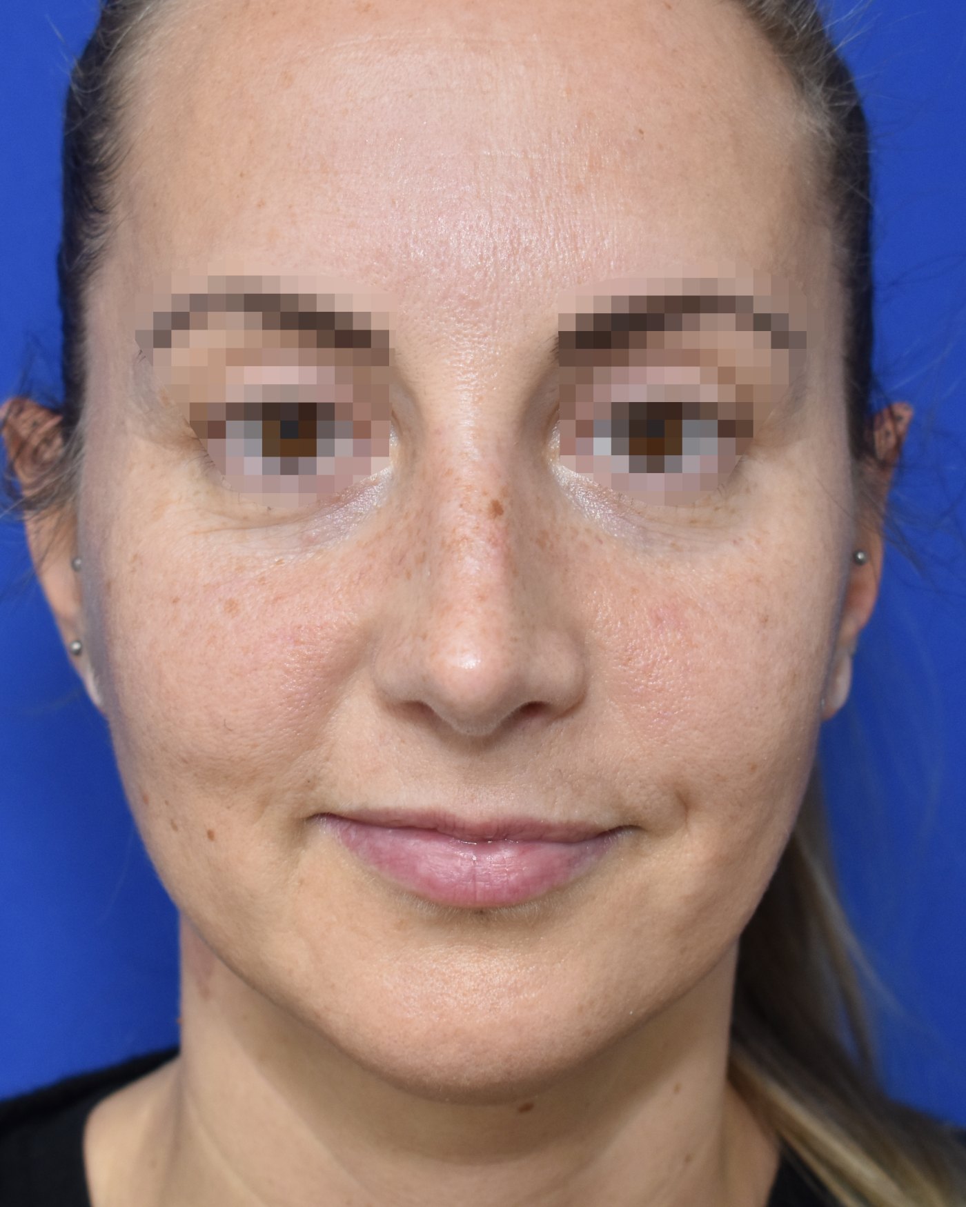 Rhinoplasty after, frontal view: Dorsal hump, Nasal tip, Nasal breathing — Case 90035, 38 Years