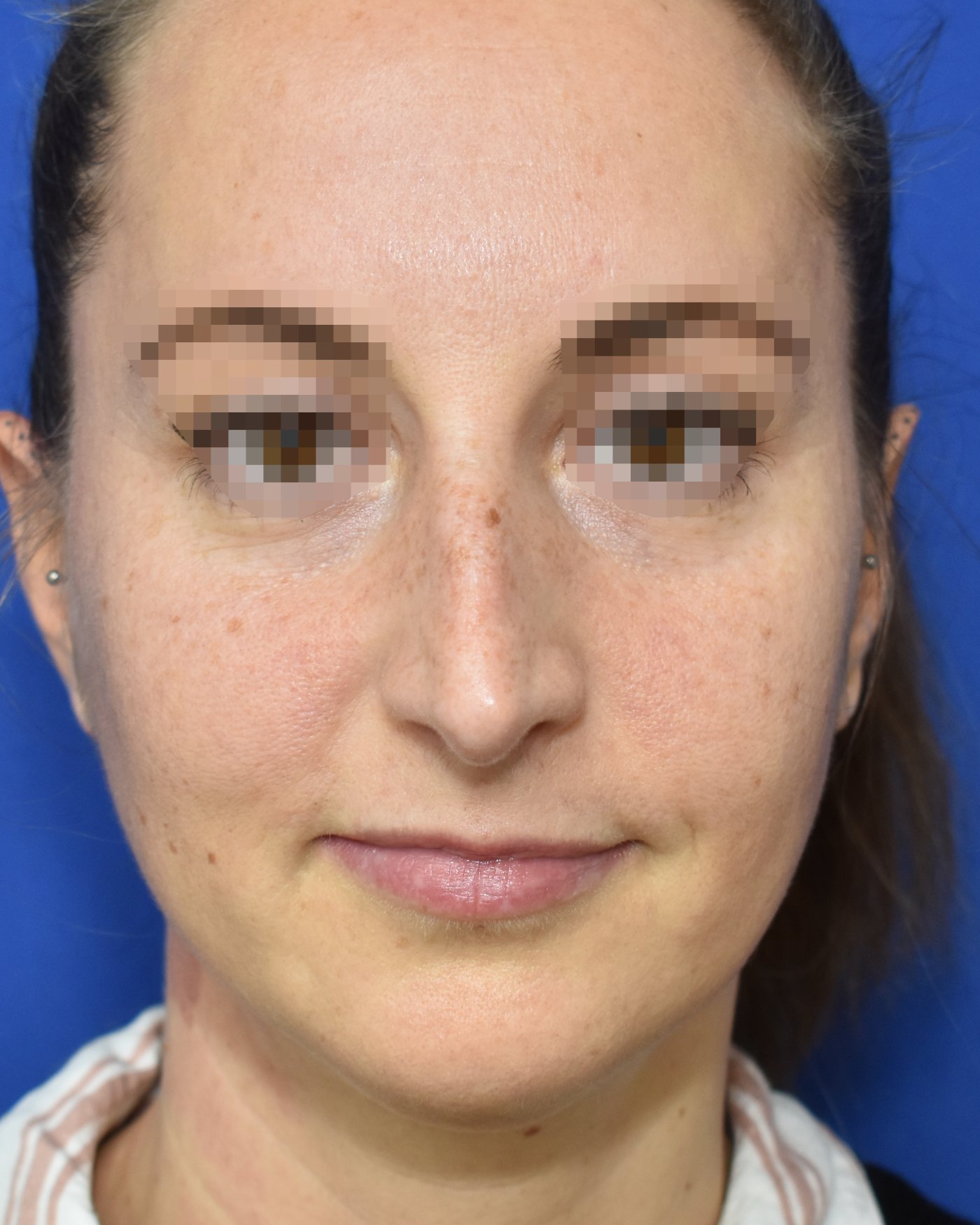 Rhinoplasty before, frontal view: Dorsal hump, Nasal tip, Nasal breathing — Case 90035, 38 Years