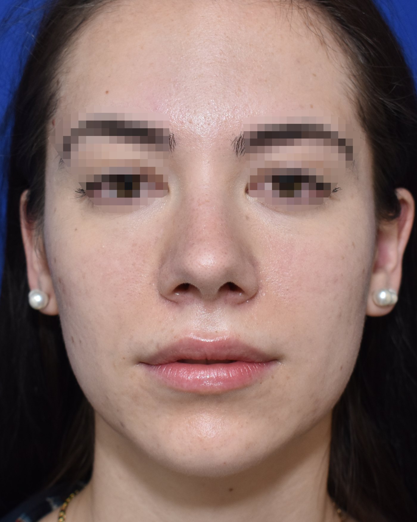 Rhinoplasty after, frontal view: Dorsal hump, Nasal tip, Nasal breathing — Case 90036, 20 Years