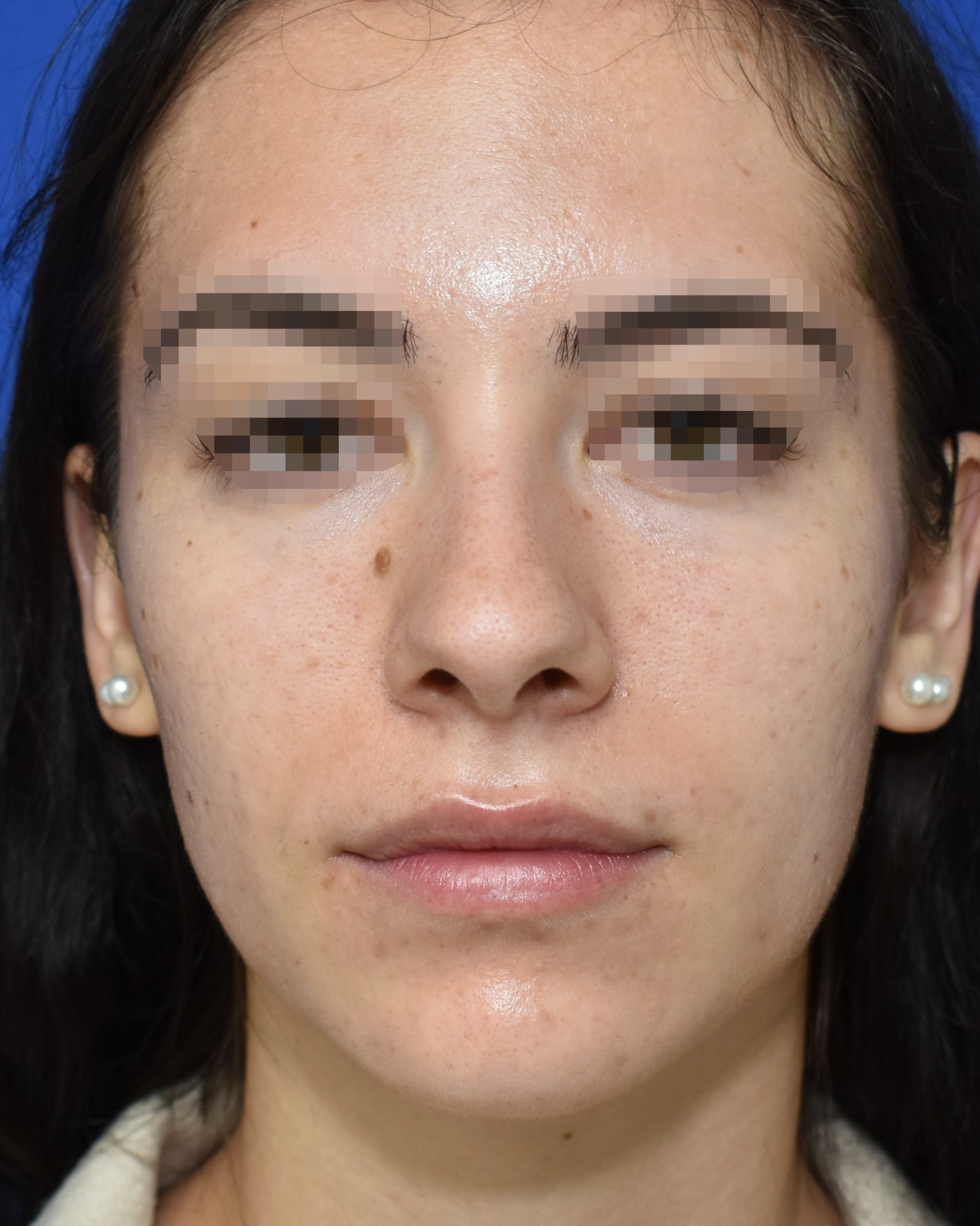 Rhinoplasty before, frontal view: Dorsal hump, Nasal tip, Nasal breathing — Case 90036, 20 Years