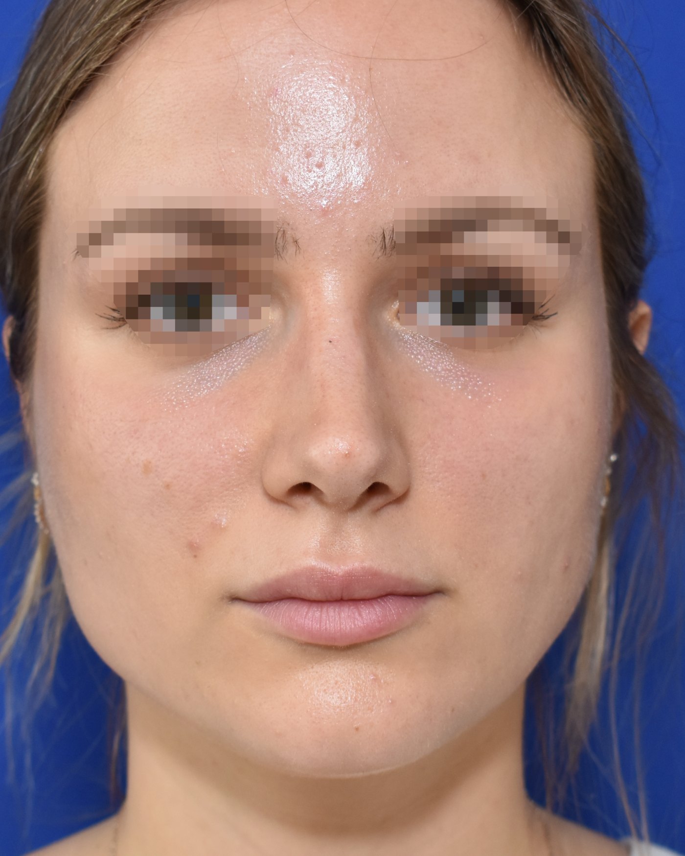 Rhinoplasty after, frontal view: Dorsal hump, Nasal tip, Oversized nose — Case 90037, 27 Years