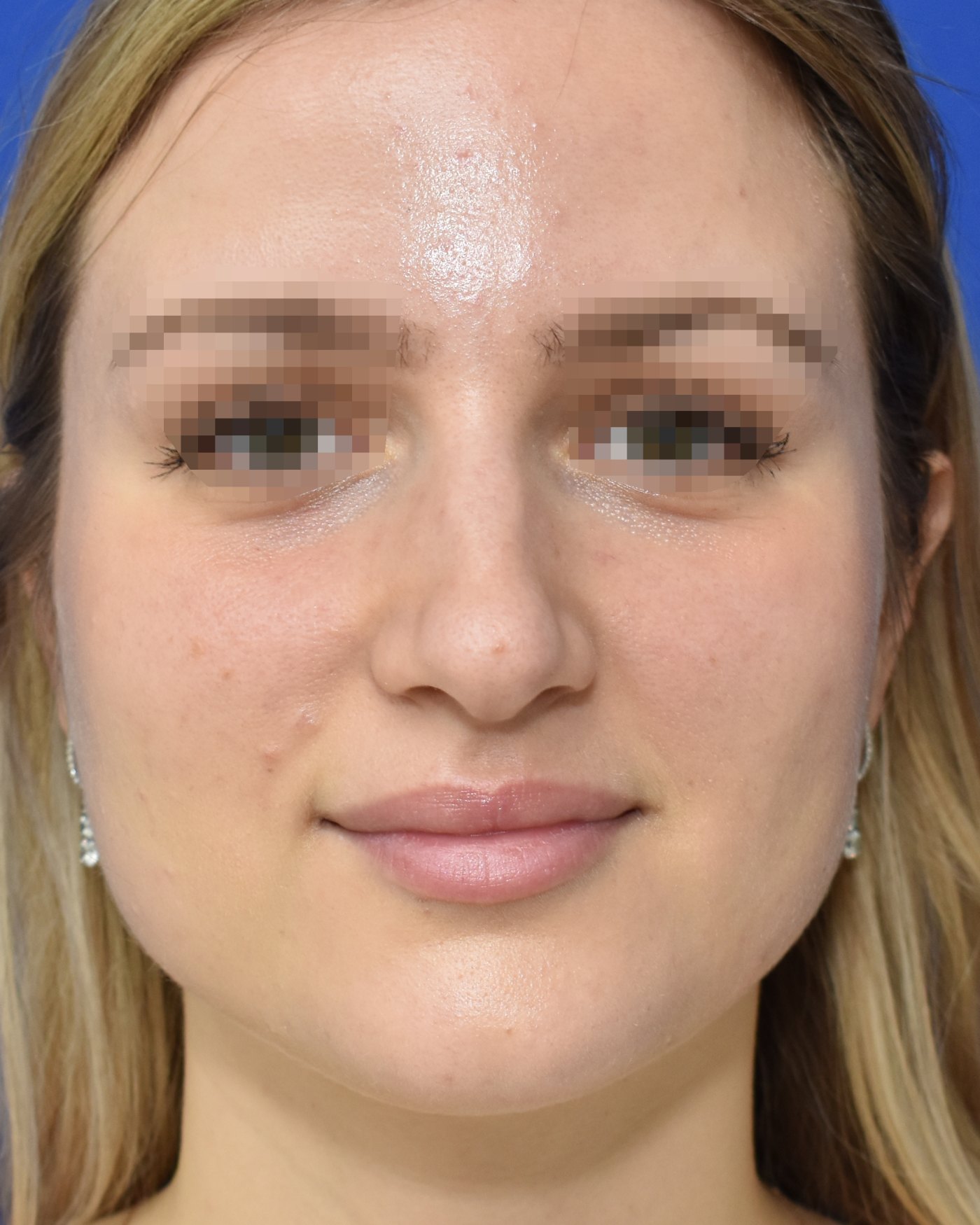 Rhinoplasty before, frontal view: Dorsal hump, Nasal tip, Oversized nose — Case 90037, 27 Years