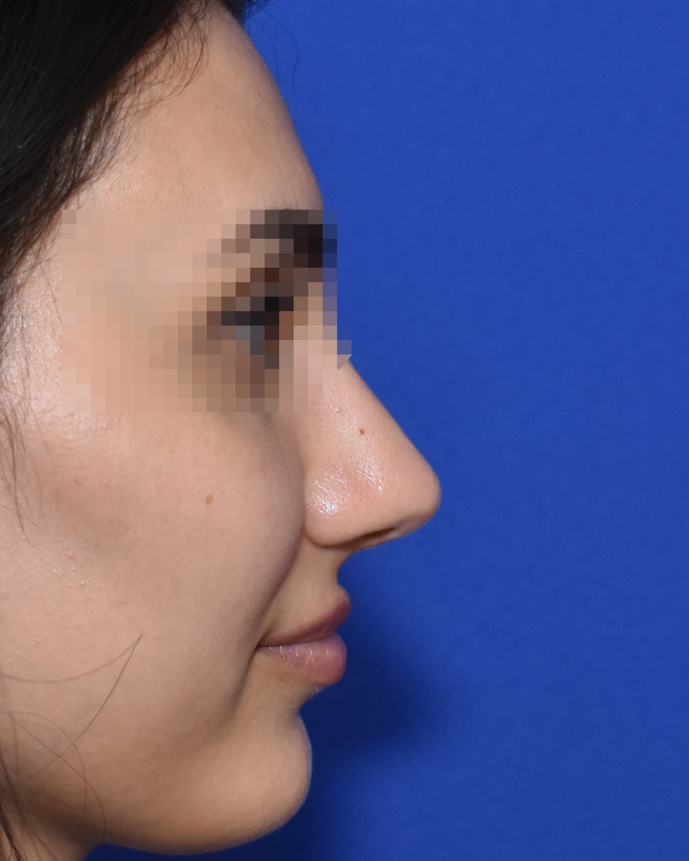 Rhinoplasty after, profile view: Dorsal hump, Nasal tip, Wide nose, Oversized nose — Case 90038, 25 Years