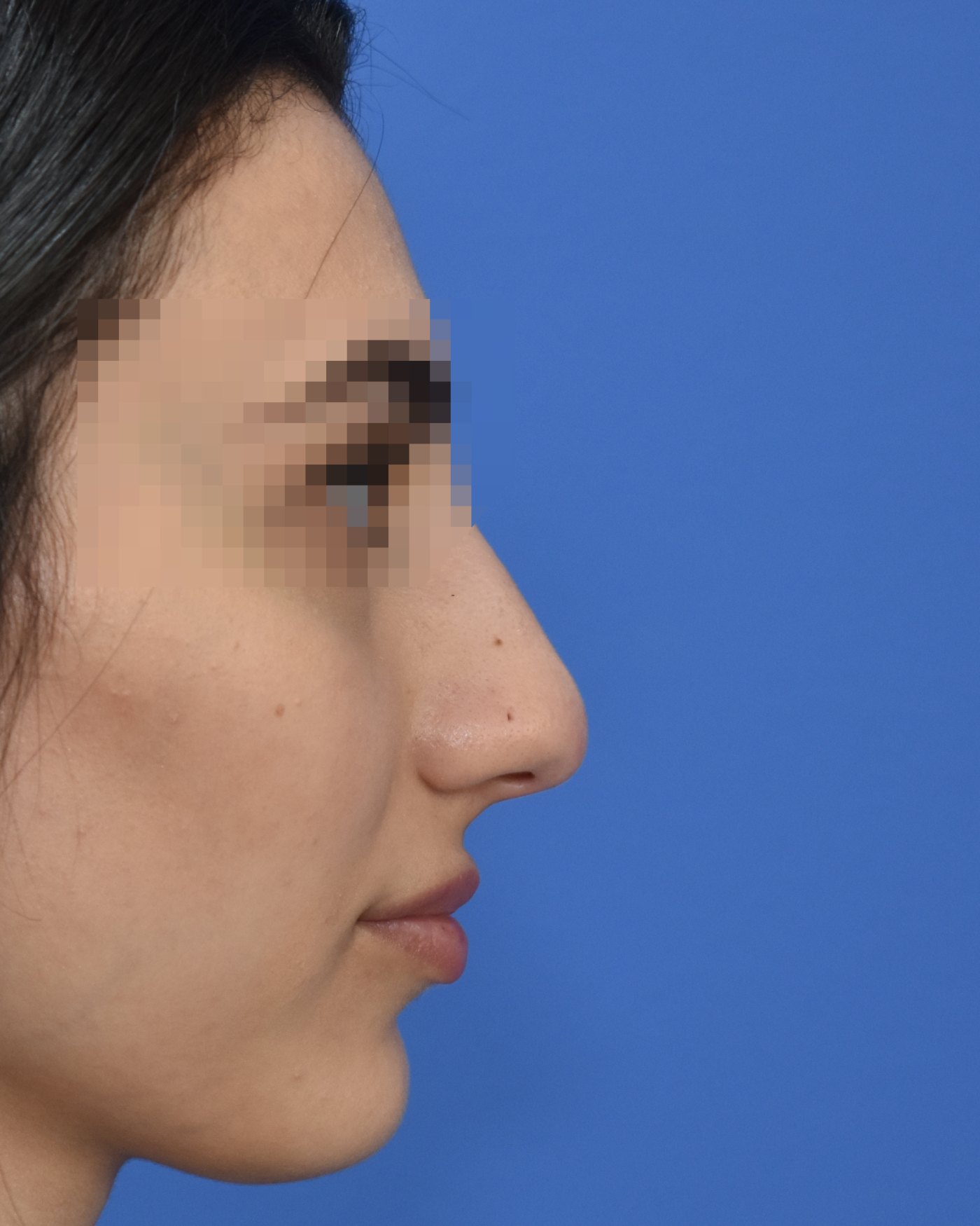 Rhinoplasty before, profile view: Dorsal hump, Nasal tip, Wide nose, Oversized nose — Case 90038, 25 Years