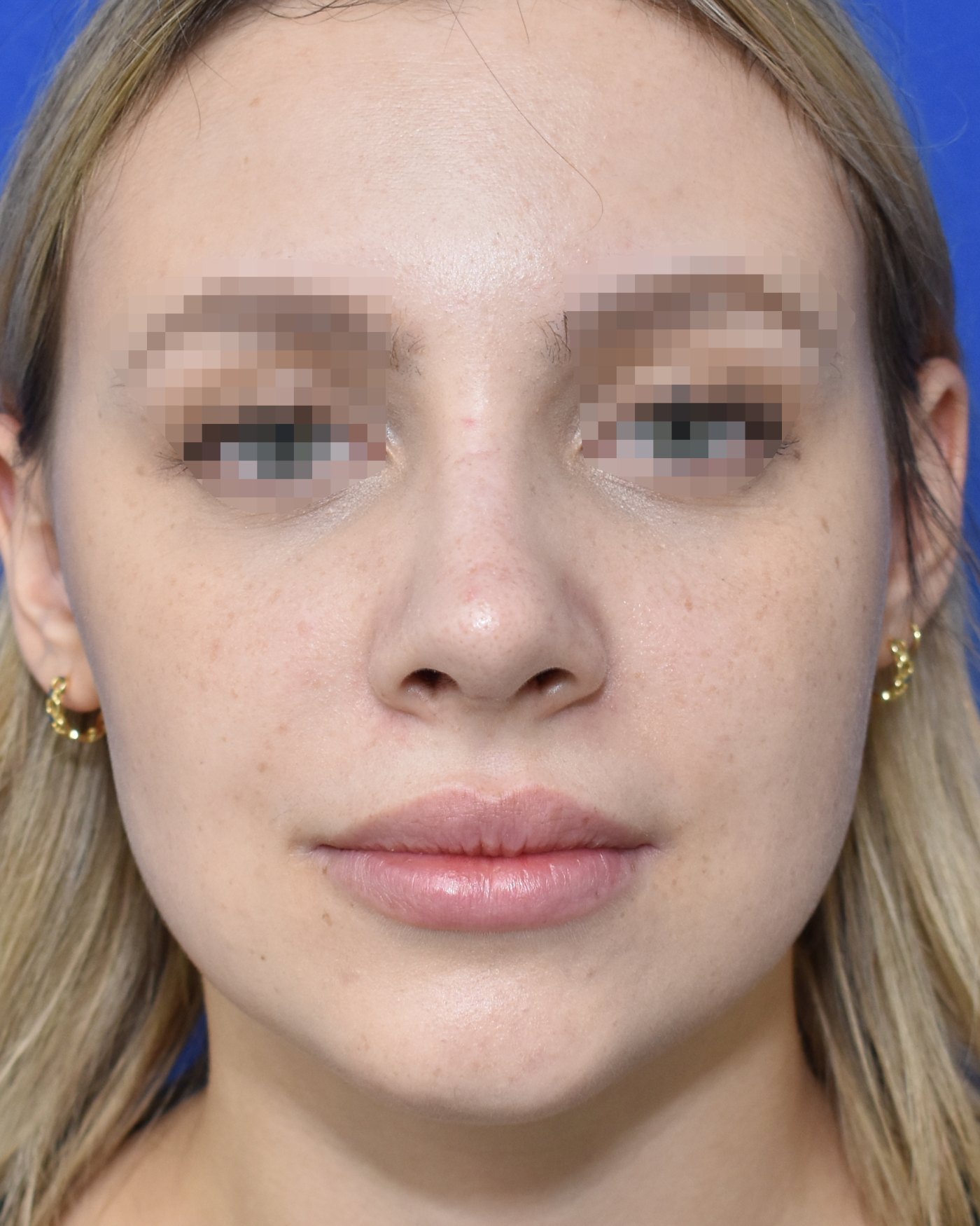 Rhinoplasty after, frontal view: Dorsal hump, Nasal tip, Oversized nose — Case 90039, 21 Years