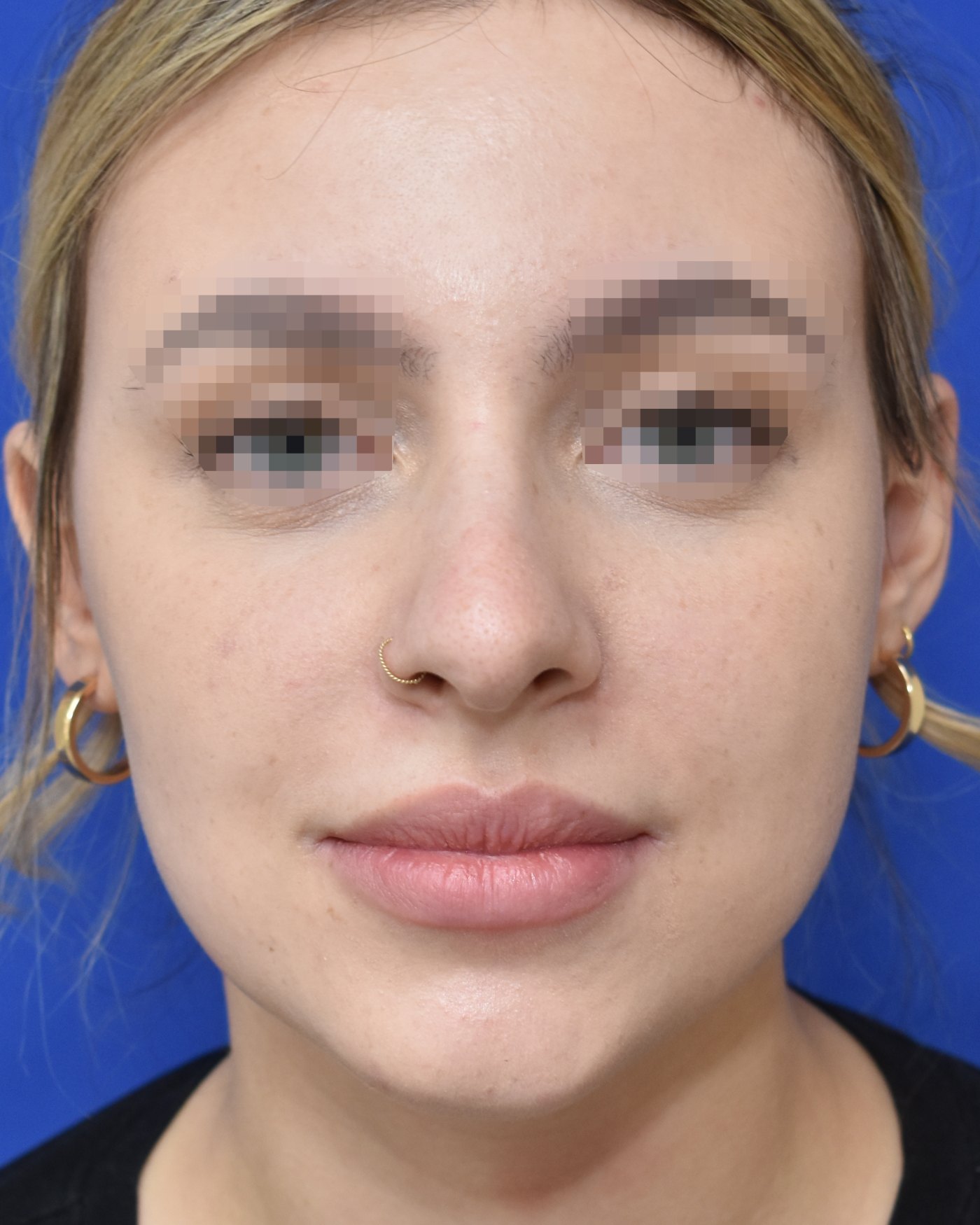 Rhinoplasty before, frontal view: Dorsal hump, Nasal tip, Oversized nose — Case 90039, 21 Years