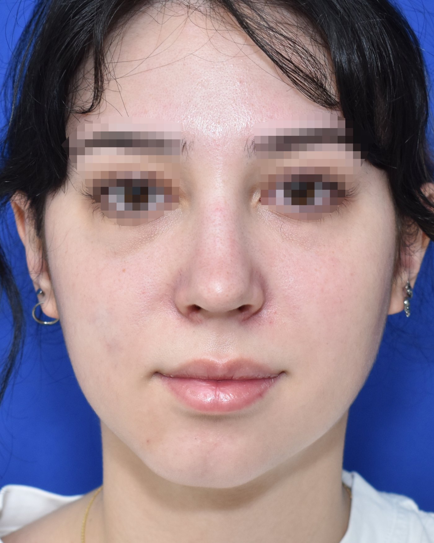Rhinoplasty after, frontal view: Dorsal hump, Nasal tip, Crooked nose, Oversized nose — Case 90040, 18 Years