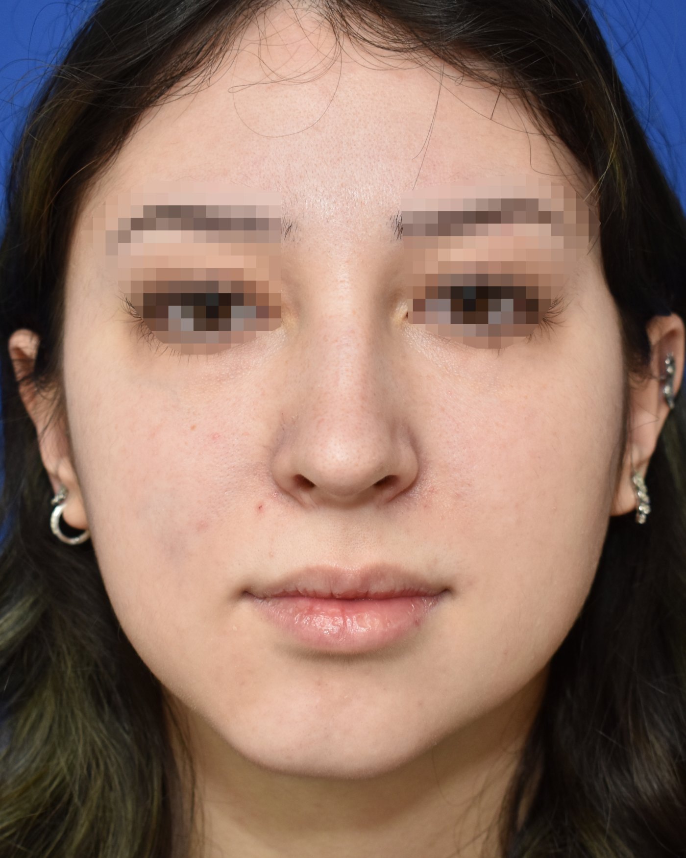 Rhinoplasty before, frontal view: Dorsal hump, Nasal tip, Crooked nose, Oversized nose — Case 90040, 18 Years