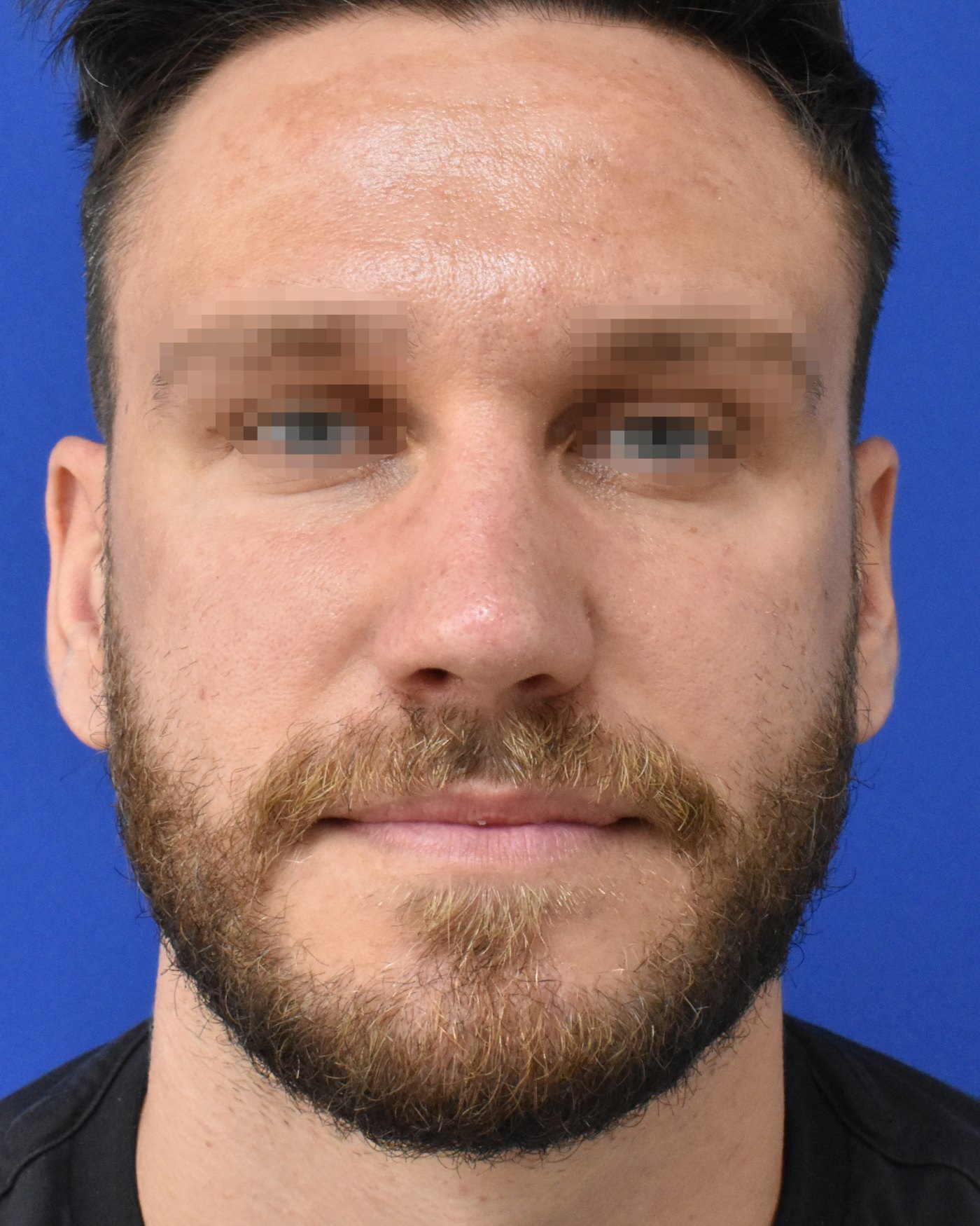 Rhinoplasty after, frontal view: Dorsal hump, Nasal tip, Crooked nose — Case 90041, 33 Years