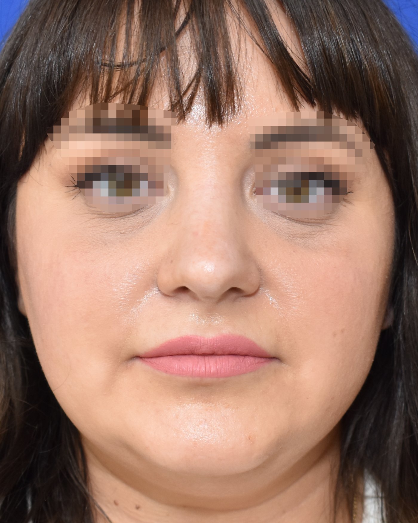 Rhinoplasty after, frontal view: Nasal tip, Wide nose, Oversized nose, Nasal breathing — Case 90042, 34 Years