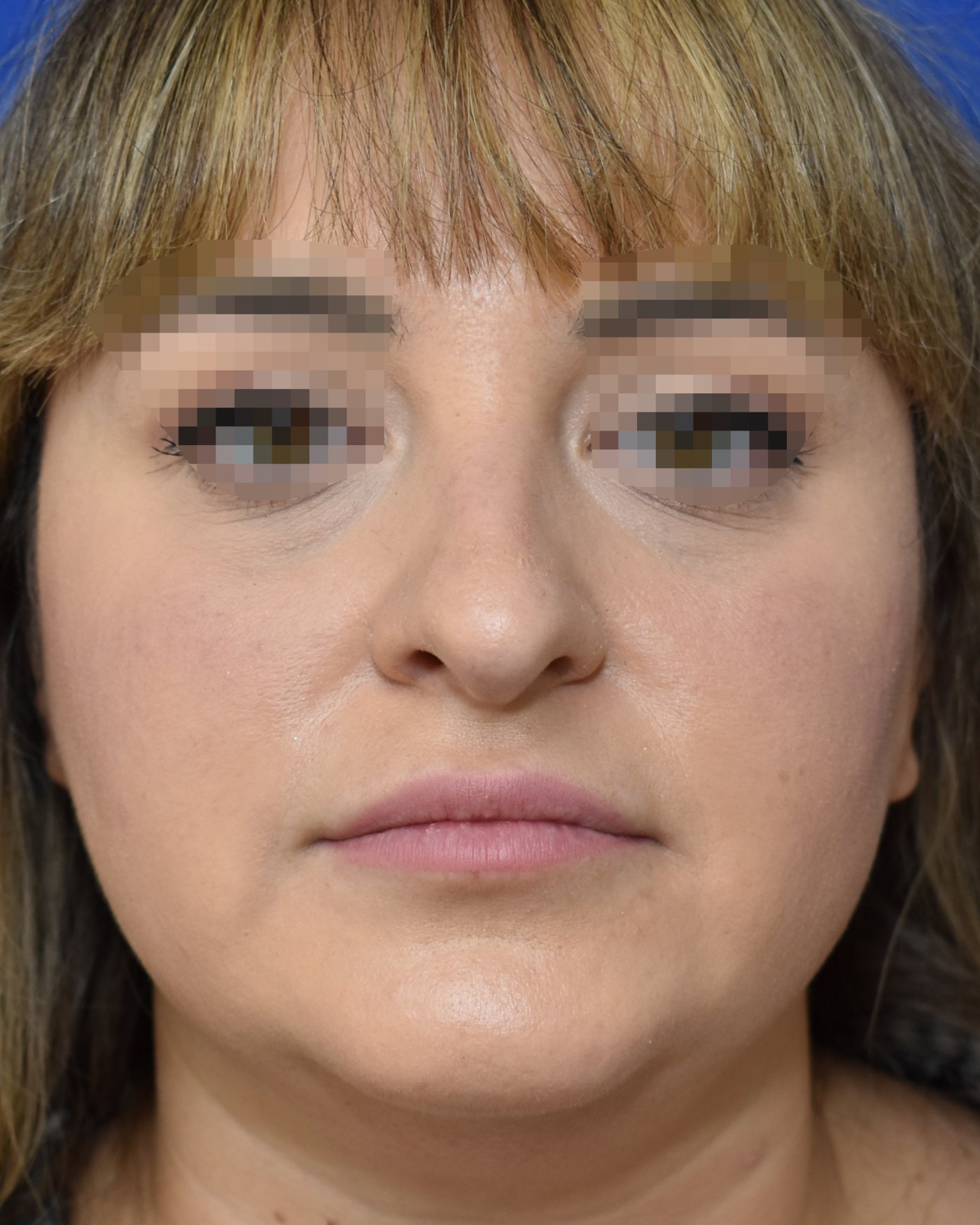 Rhinoplasty before, frontal view: Nasal tip, Wide nose, Oversized nose, Nasal breathing — Case 90042, 34 Years
