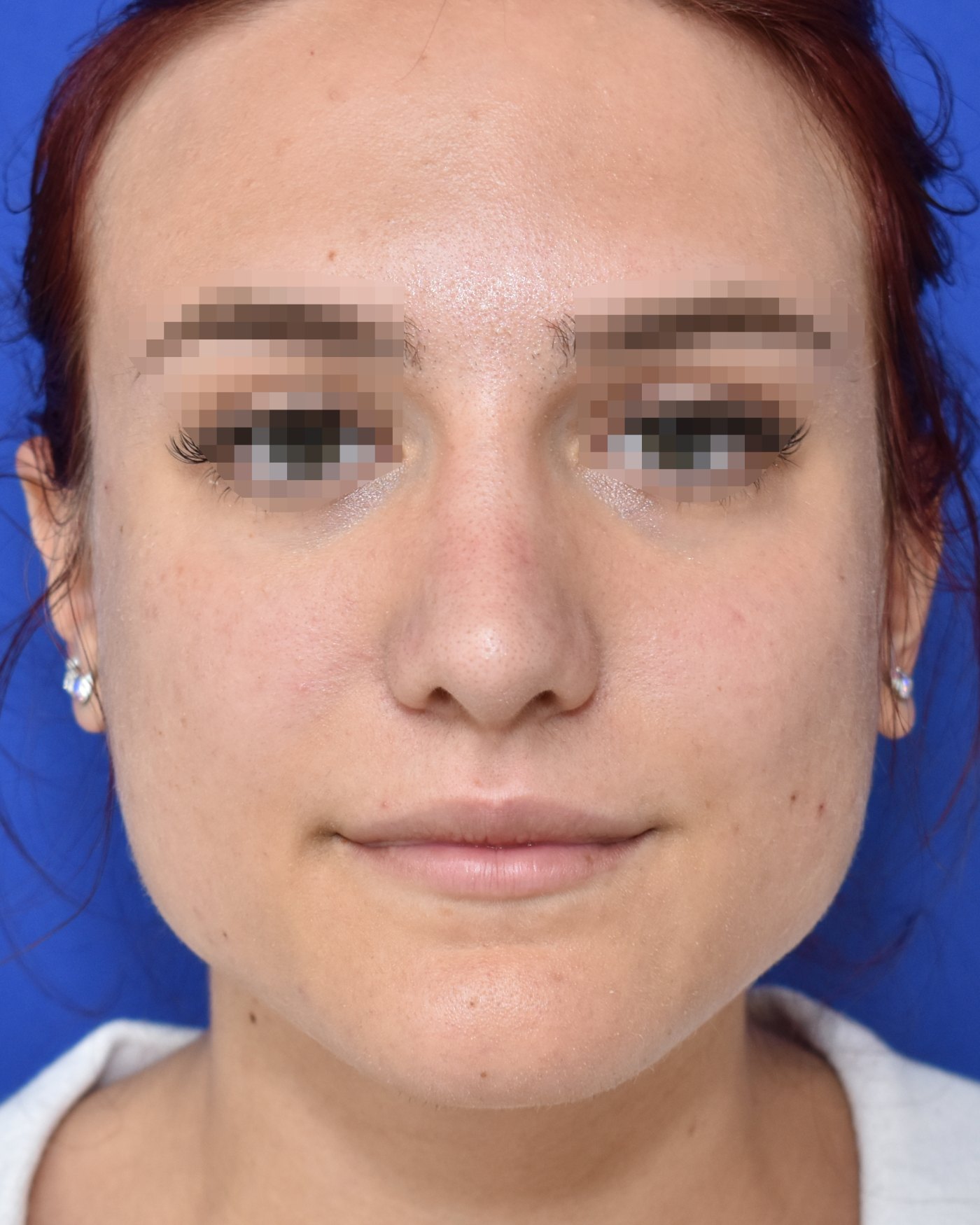 Rhinoplasty after, frontal view: Dorsal hump, Nasal tip, Wide nose, Nasal breathing — Case 90043, 21 Years