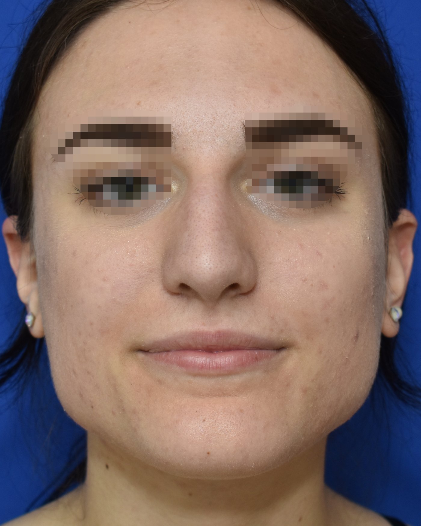 Rhinoplasty before, frontal view: Dorsal hump, Nasal tip, Wide nose, Nasal breathing — Case 90043, 21 Years