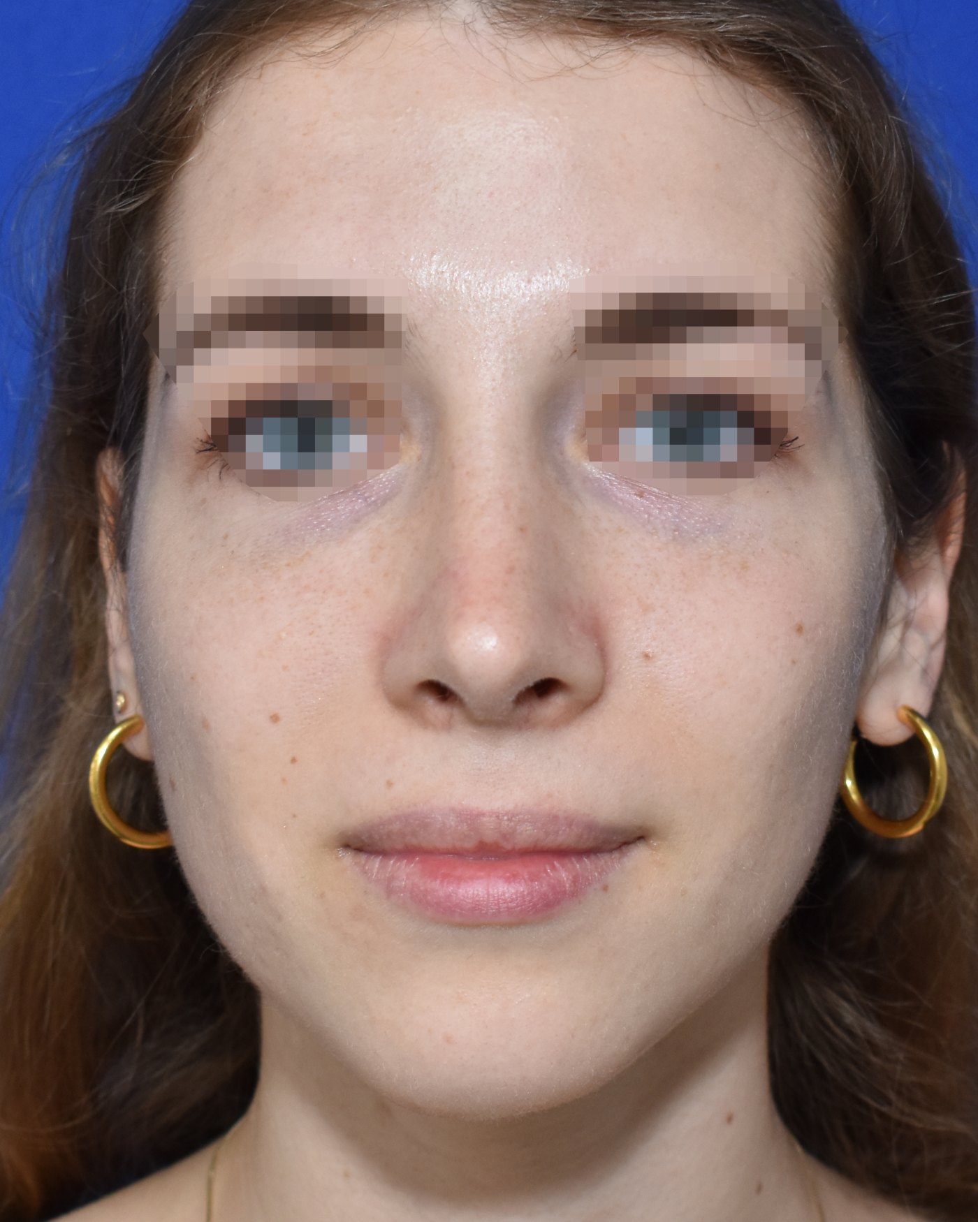 Rhinoplasty after, frontal view: Nasal breathing — Case 90044, 23 Years
