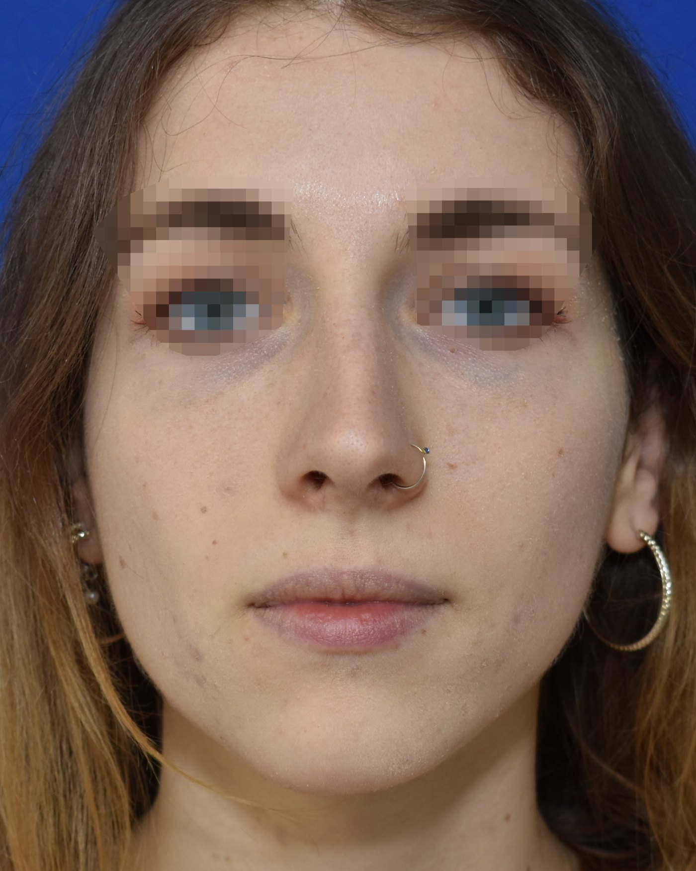 Rhinoplasty before, frontal view: Nasal breathing — Case 90044, 23 Years