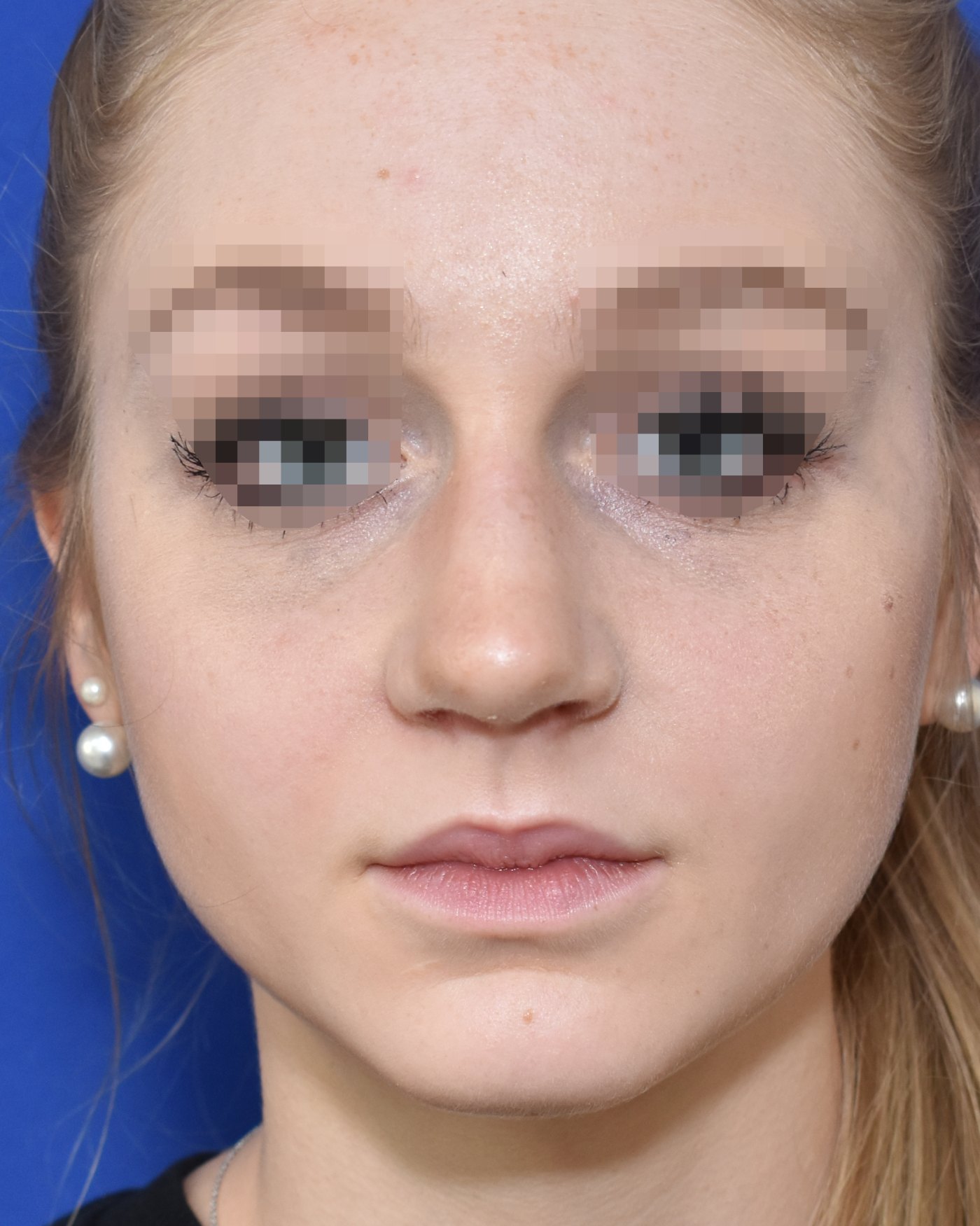 Rhinoplasty after, frontal view: Dorsal hump, Nasal tip, Wide nose, Oversized nose — Case 90045, 21 Years