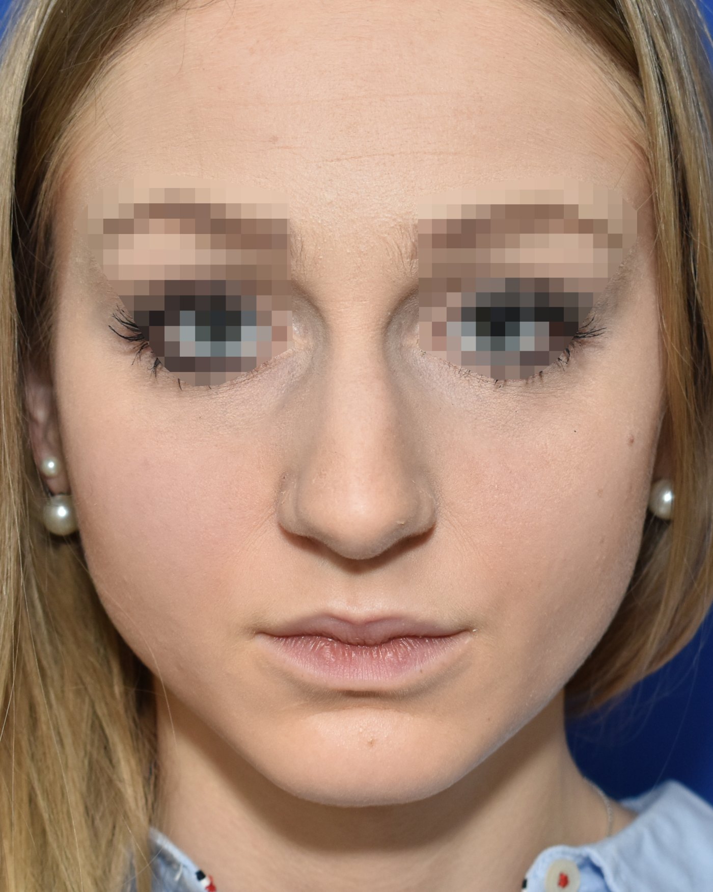 Rhinoplasty before, frontal view: Dorsal hump, Nasal tip, Wide nose, Oversized nose — Case 90045, 21 Years