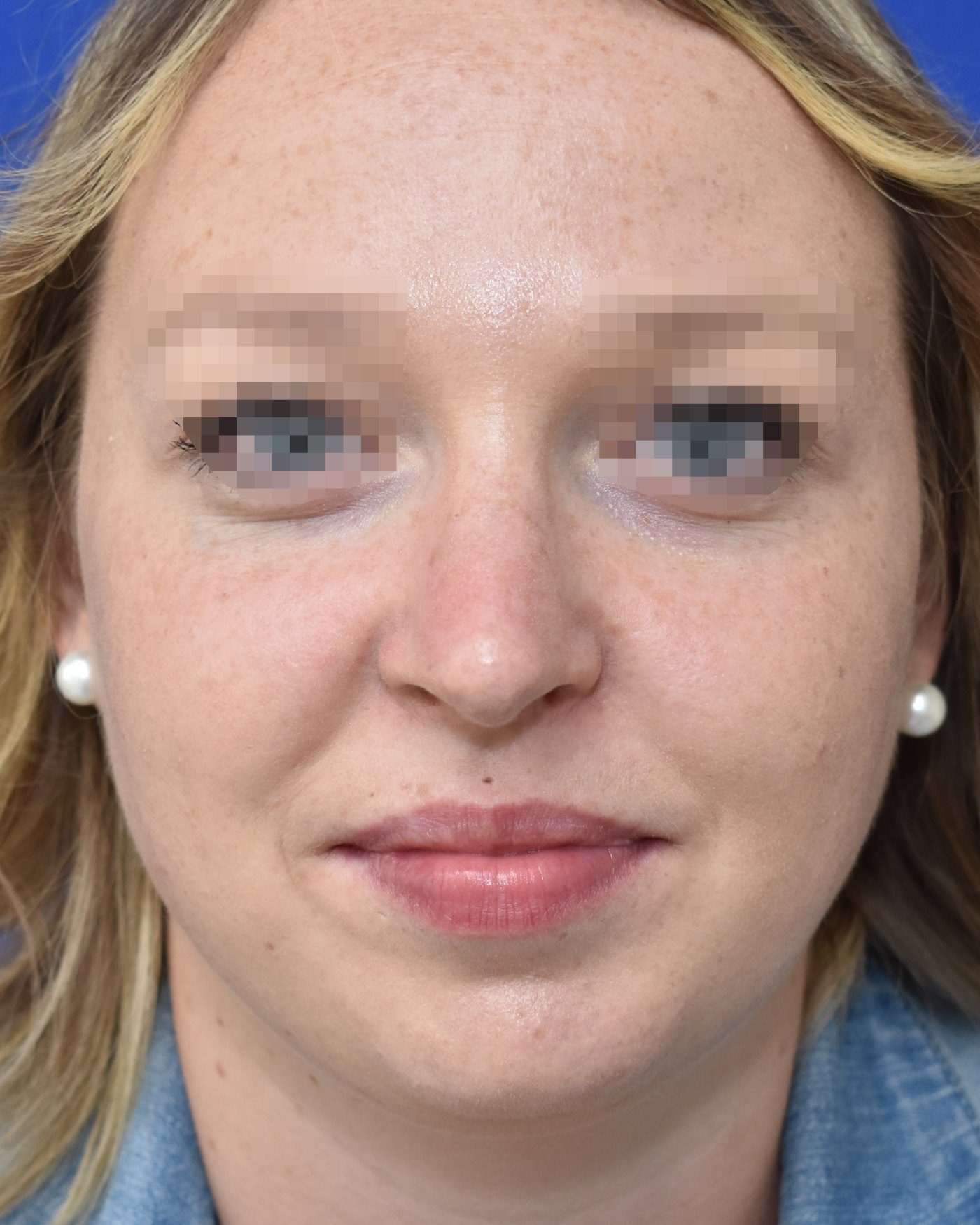 Rhinoplasty after, frontal view: Dorsal hump, Nasal tip, Oversized nose — Case 90046, 22 Years