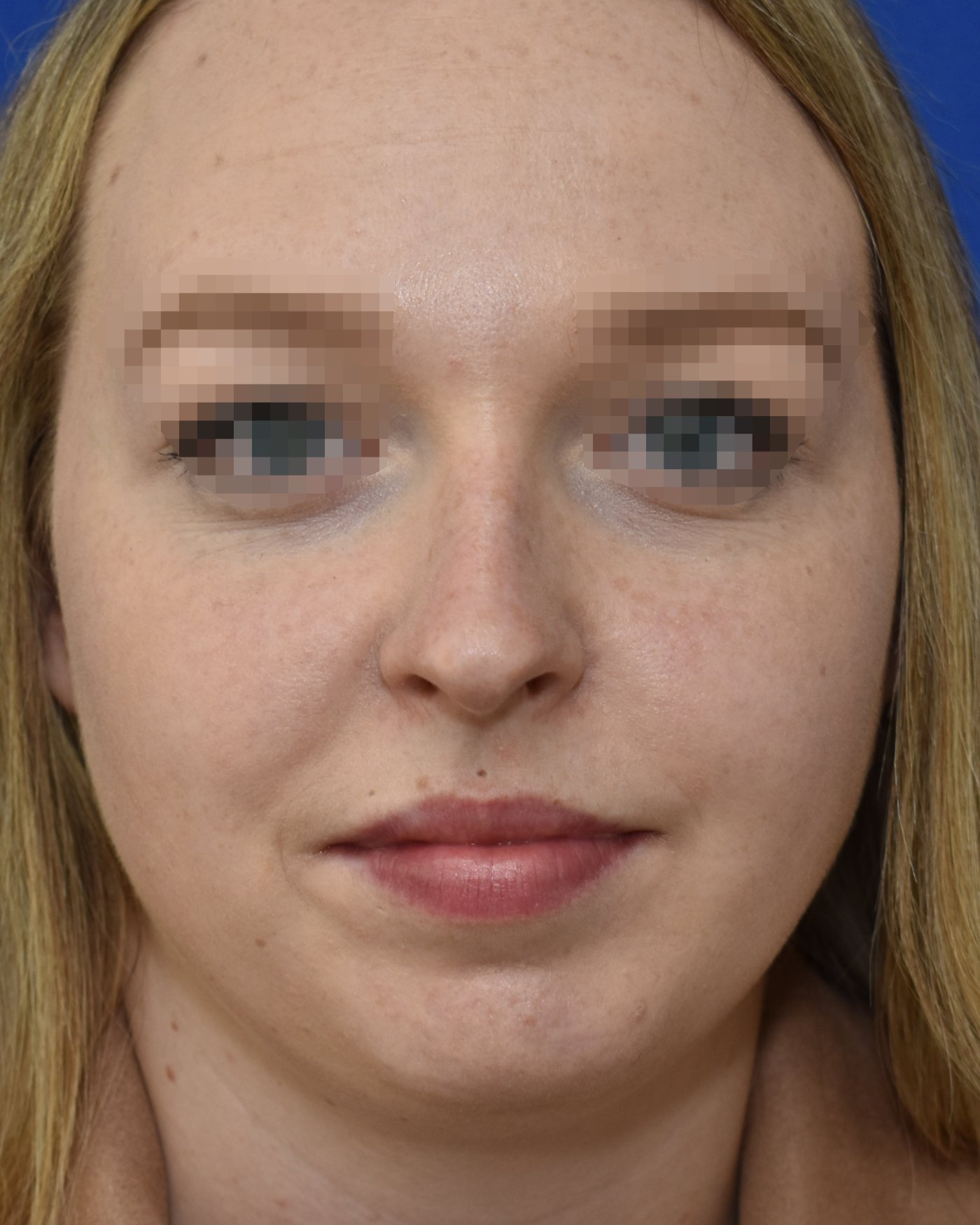 Rhinoplasty before, frontal view: Dorsal hump, Nasal tip, Oversized nose — Case 90046, 22 Years