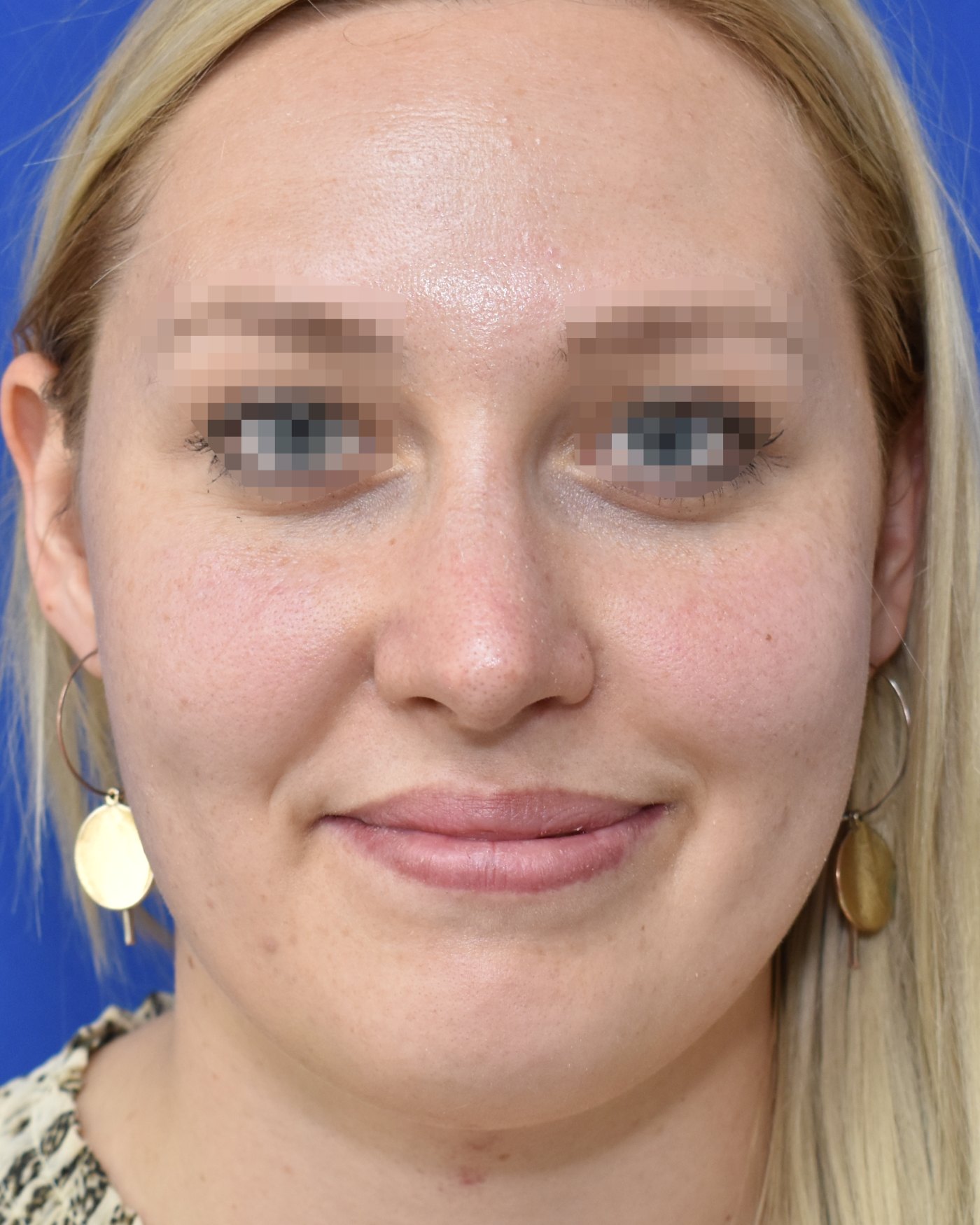 Rhinoplasty after, frontal view: Dorsal hump, Nasal tip, Oversized nose — Case 90047, 24 Years