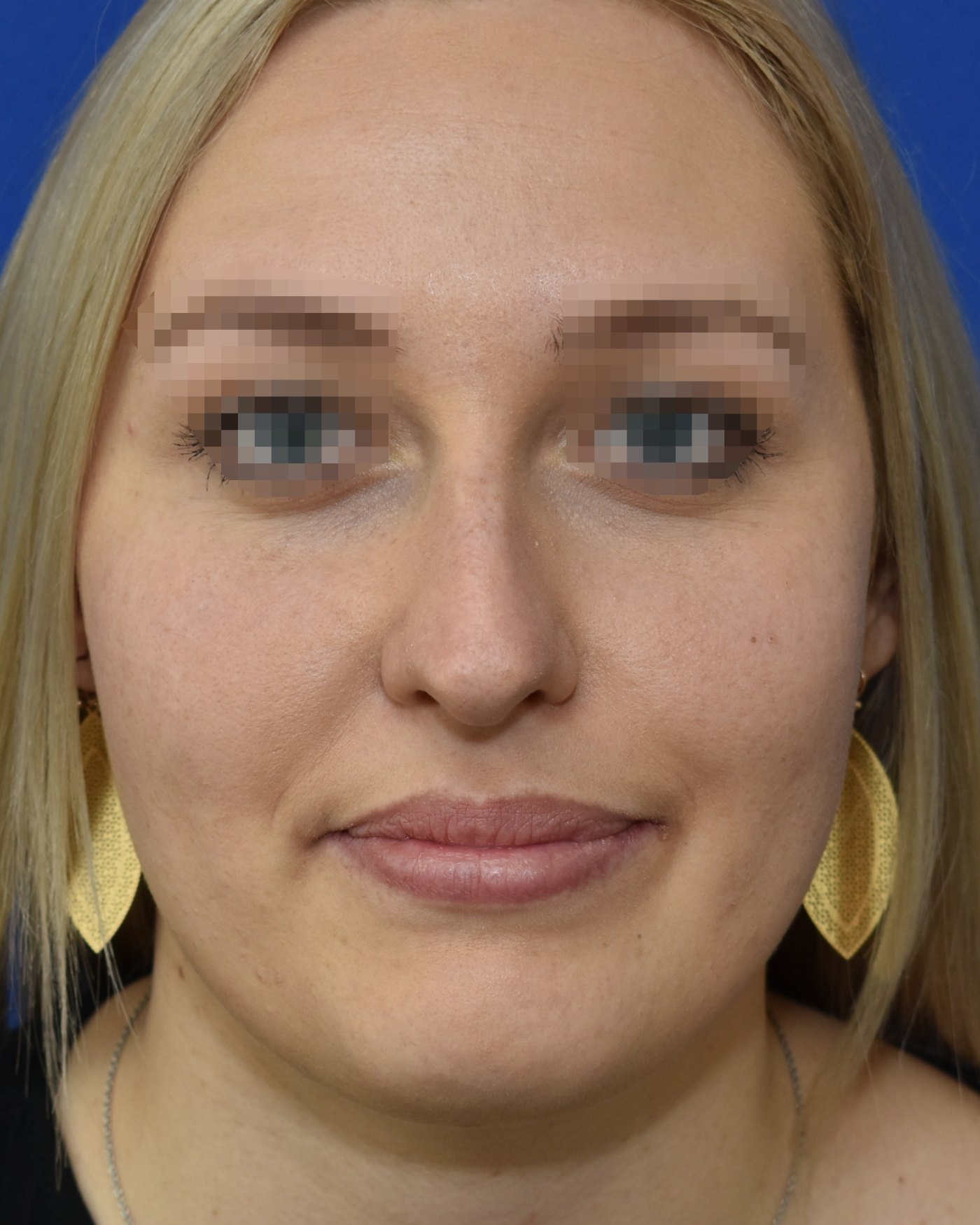Rhinoplasty before, frontal view: Dorsal hump, Nasal tip, Oversized nose — Case 90047, 24 Years
