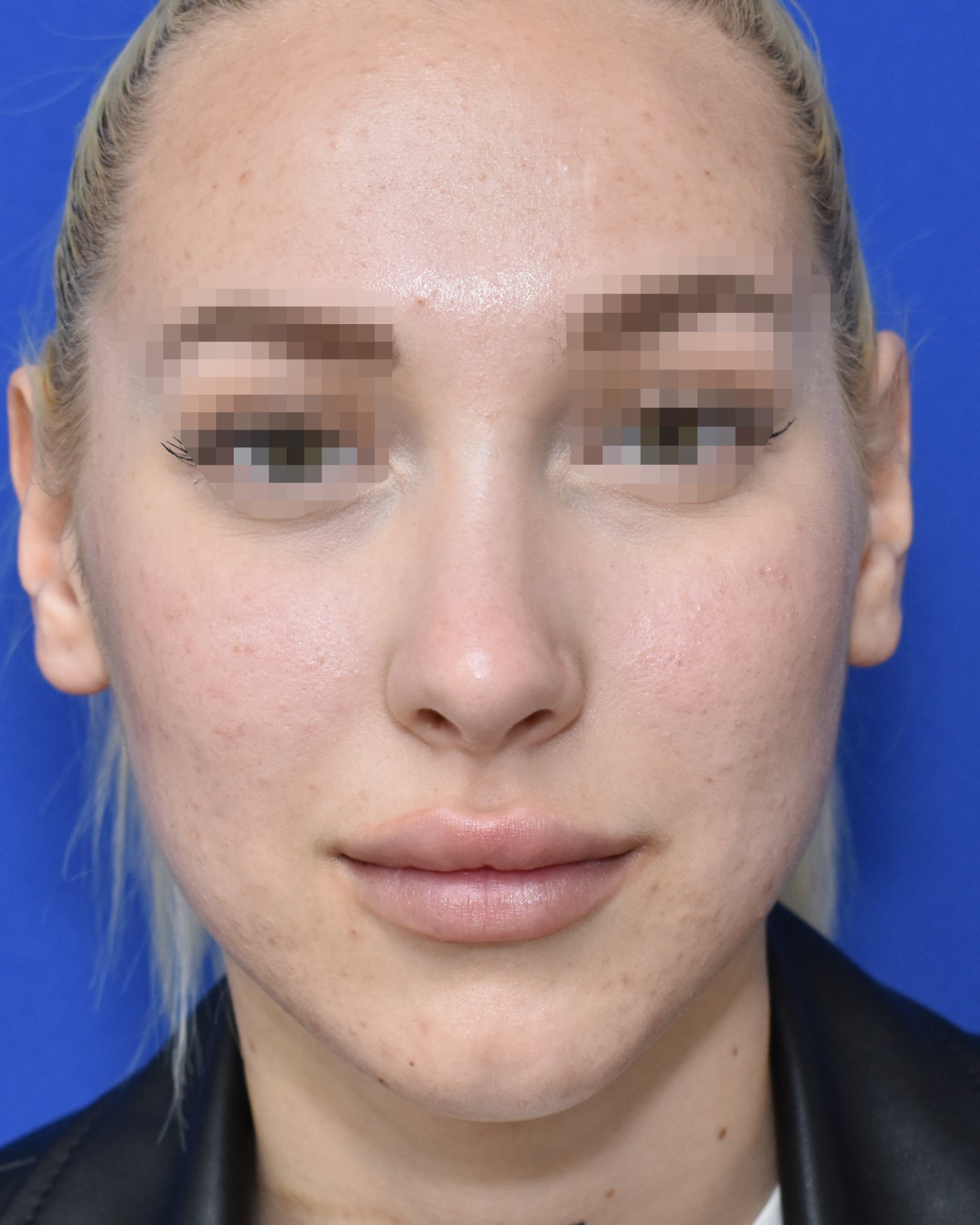 Rhinoplasty after, frontal view: Dorsal hump, Nasal tip, Crooked nose, Wide nose — Case 90048, 20 Years
