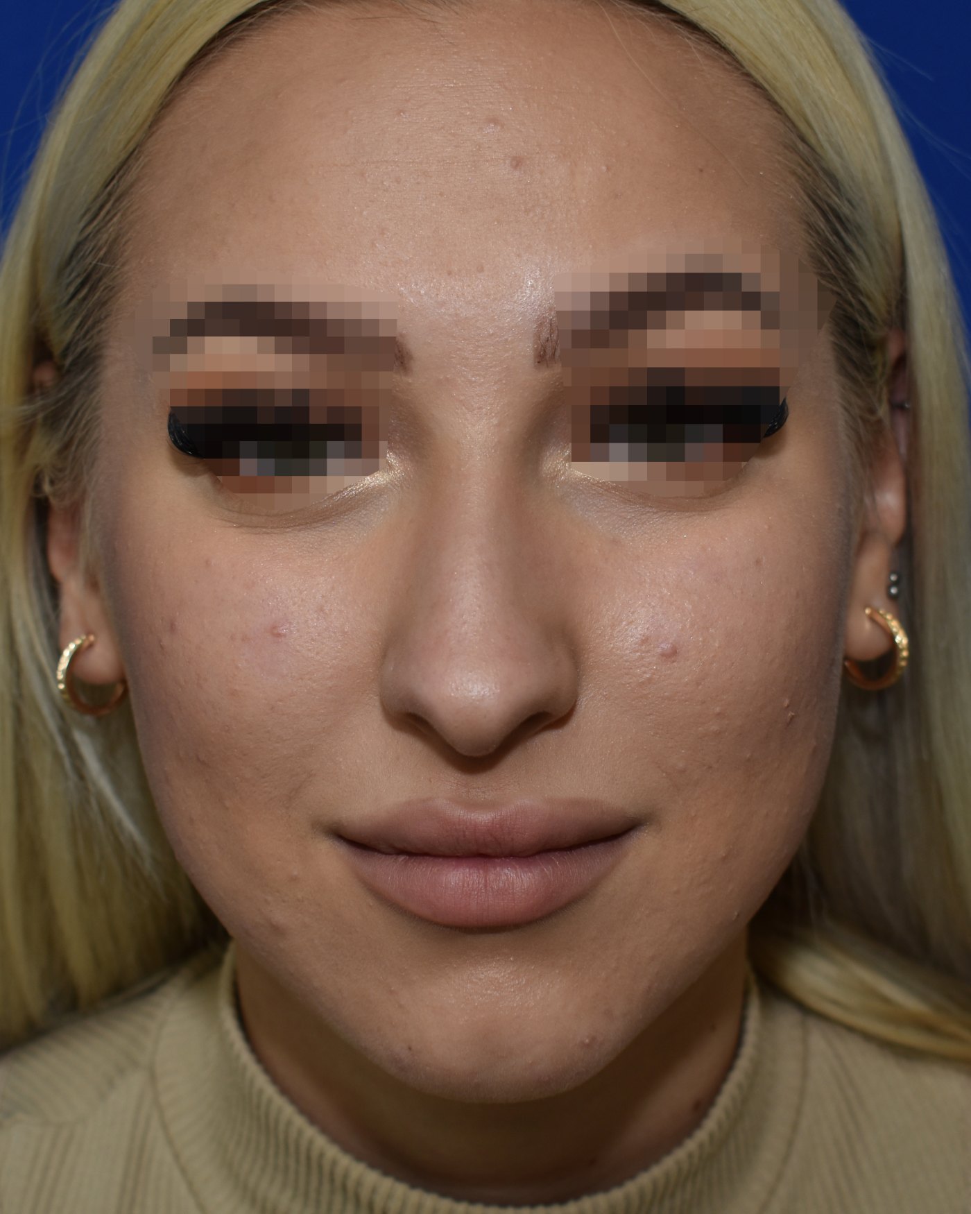 Rhinoplasty before, frontal view: Dorsal hump, Nasal tip, Crooked nose, Wide nose — Case 90048, 20 Years
