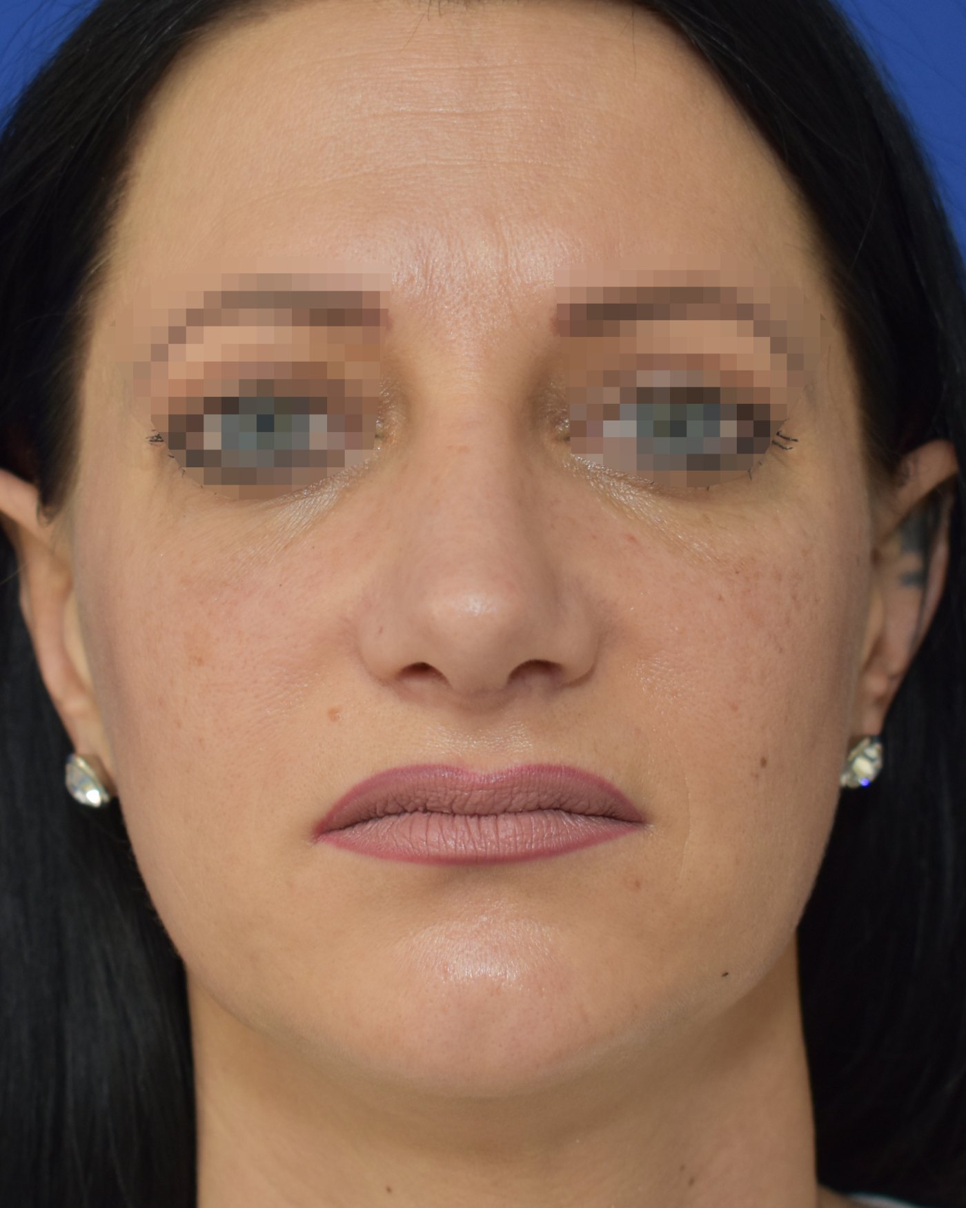 Rhinoplasty after, frontal view: Nasal tip, Oversized nose, Nasal breathing — Case 90049, 39 Years
