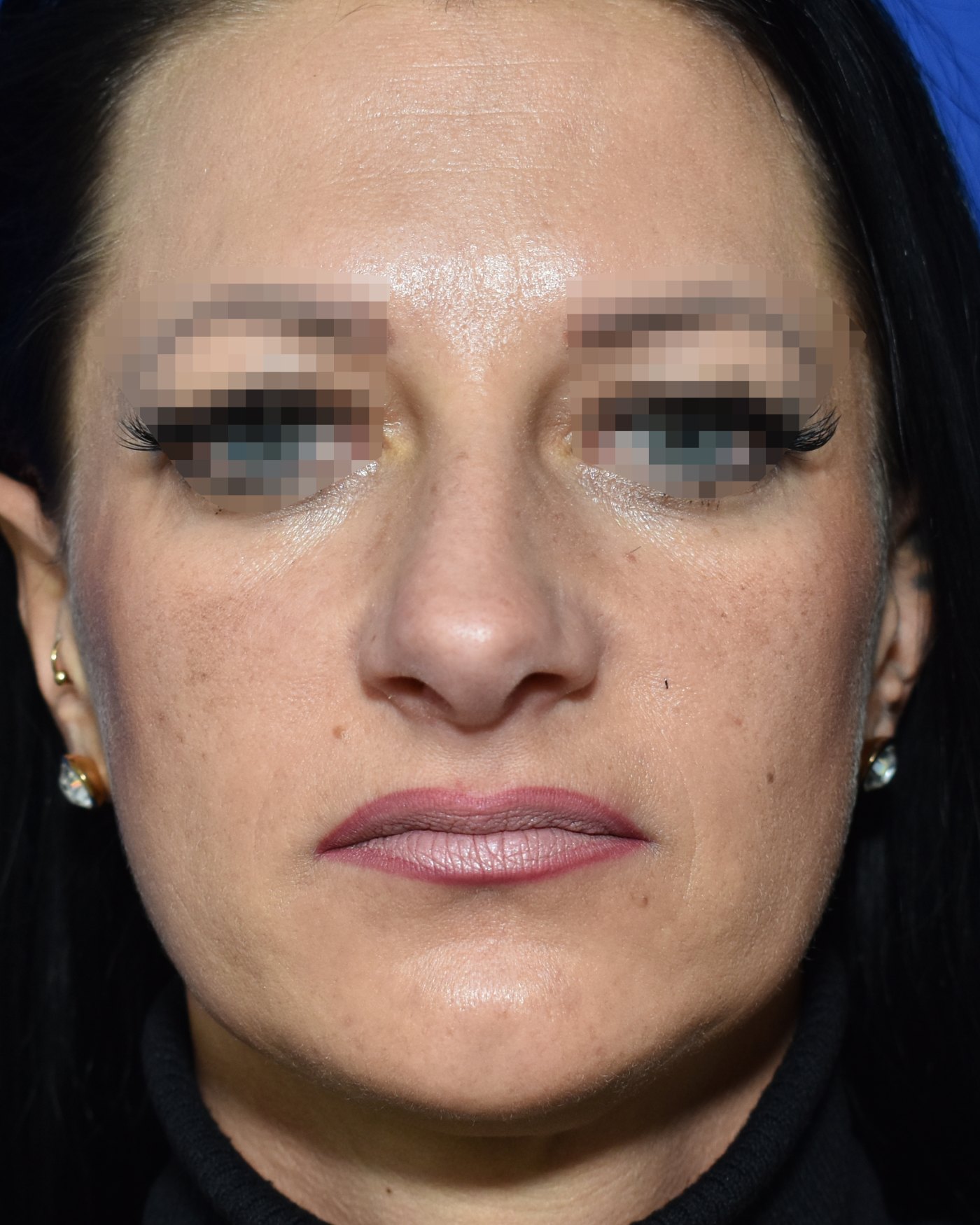 Rhinoplasty before, frontal view: Nasal tip, Oversized nose, Nasal breathing — Case 90049, 39 Years