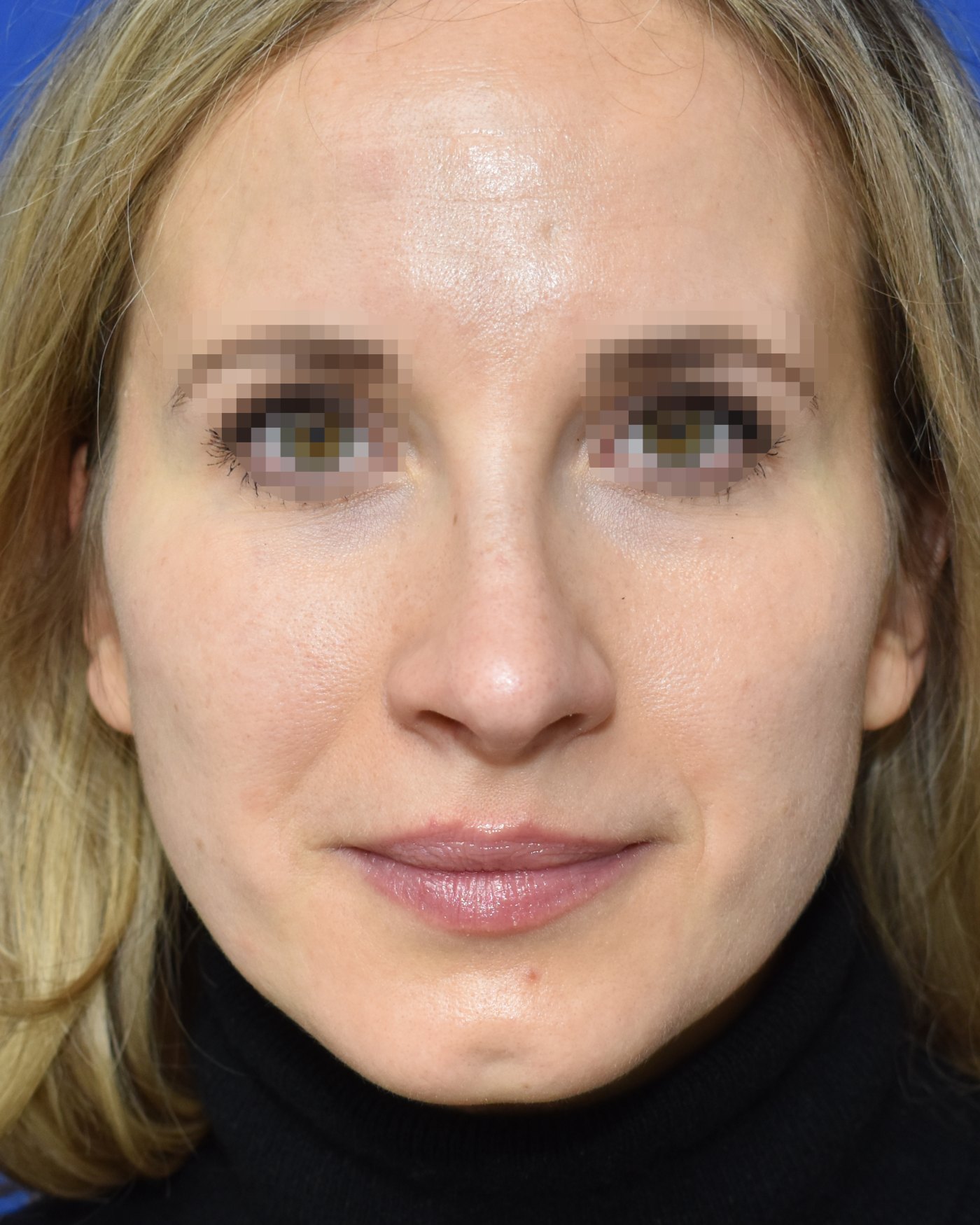 Rhinoplasty after, frontal view: Nasal tip, Crooked nose, Wide nose, Oversized nose — Case 90050, 30 Years