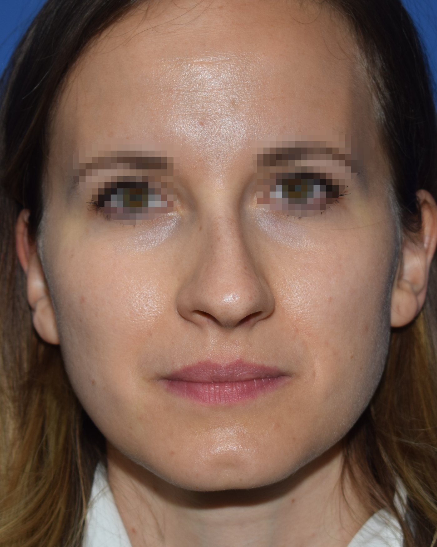 Rhinoplasty before, frontal view: Nasal tip, Crooked nose, Wide nose, Oversized nose — Case 90050, 30 Years