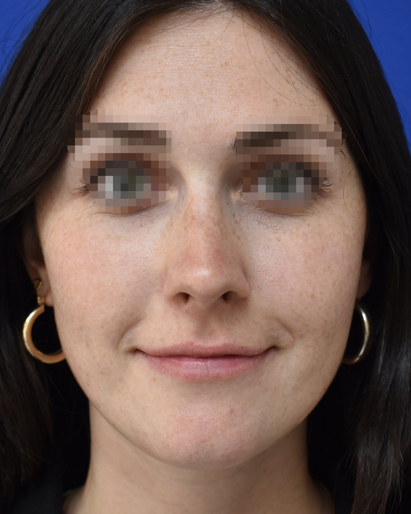 Rhinoplasty after, frontal view: Dorsal hump, Nasal tip, Oversized nose — Case 90051, 23 Years