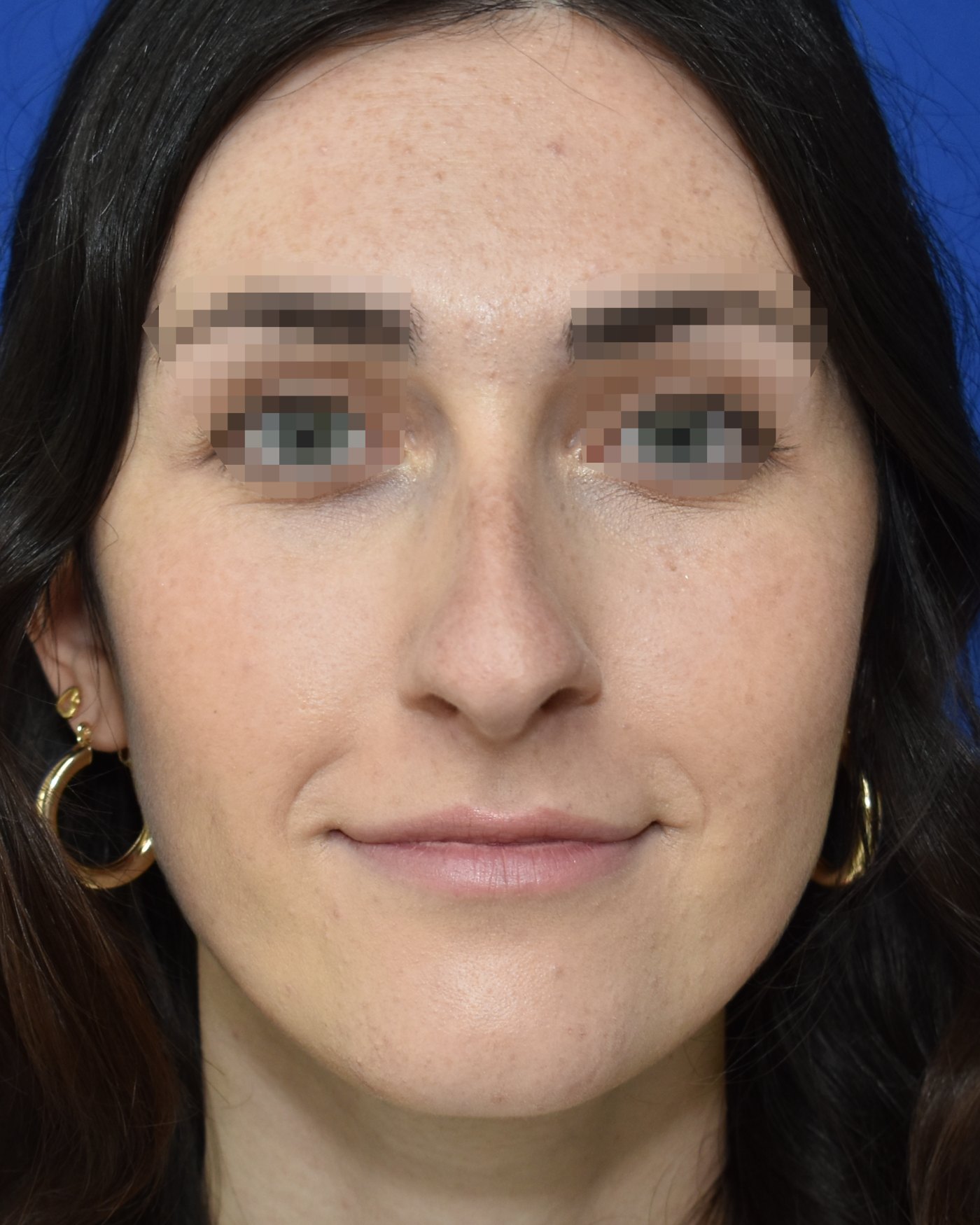 Rhinoplasty before, frontal view: Dorsal hump, Nasal tip, Oversized nose — Case 90051, 23 Years