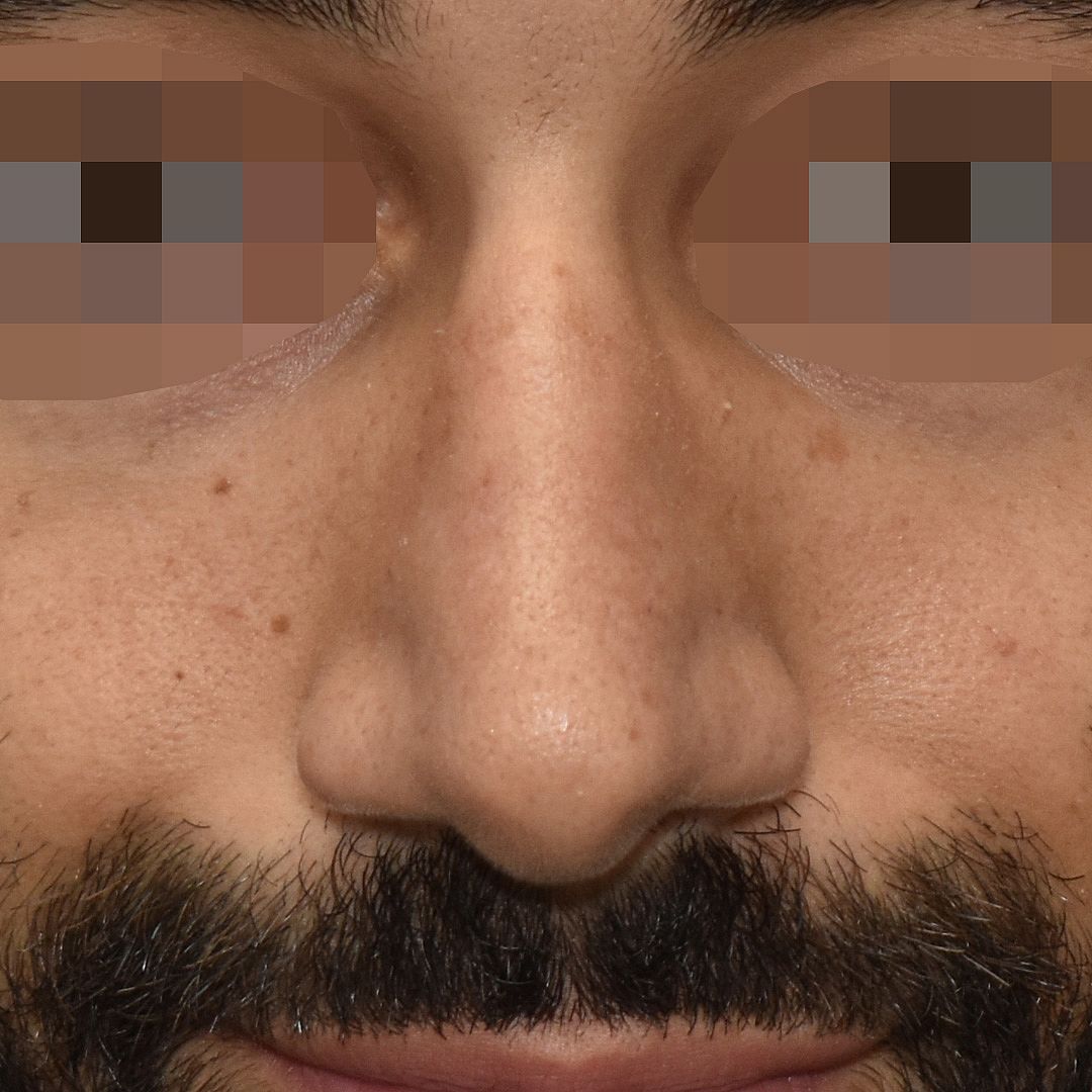 Nasenkorrektur, 28 Vorher Nachher