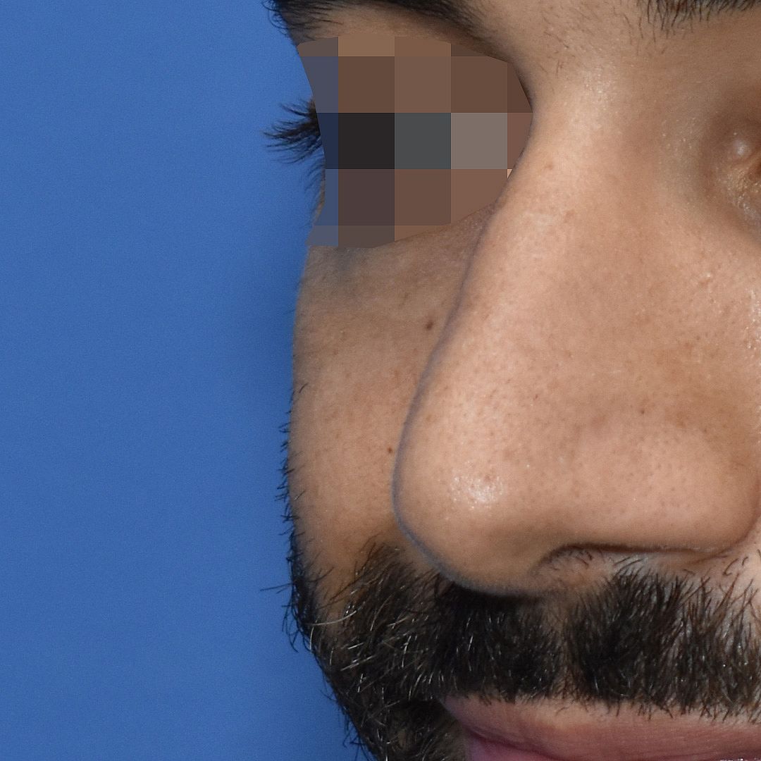 Nasenkorrektur, 28 Vorher Nachher