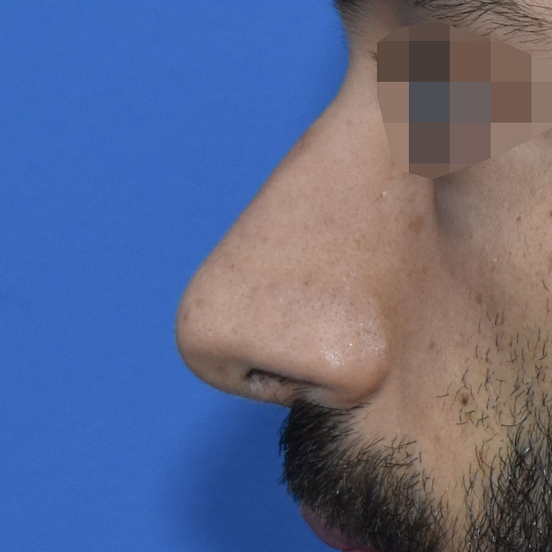 Nasenkorrektur, 28 Vorher Nachher
