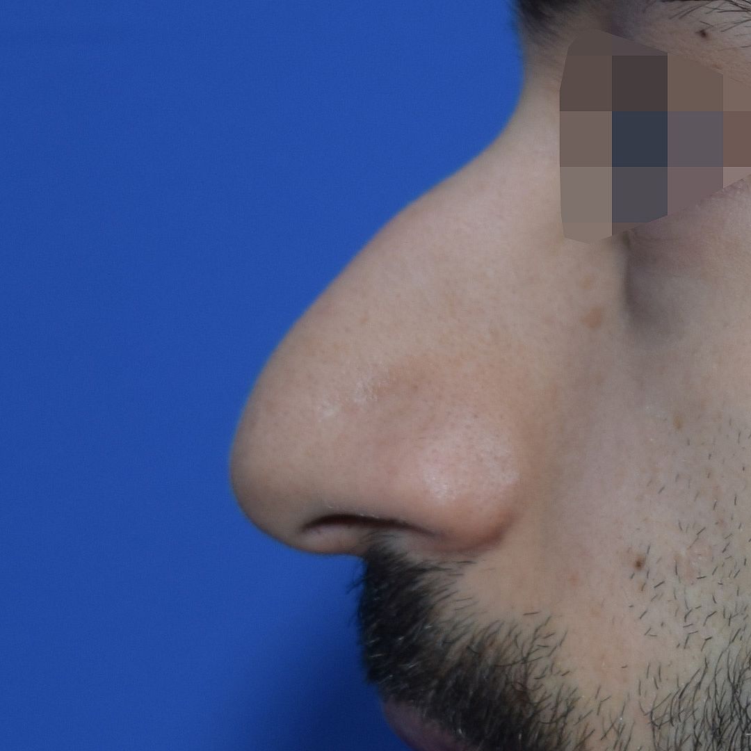 Nasenkorrektur, 28 Vorher Nachher