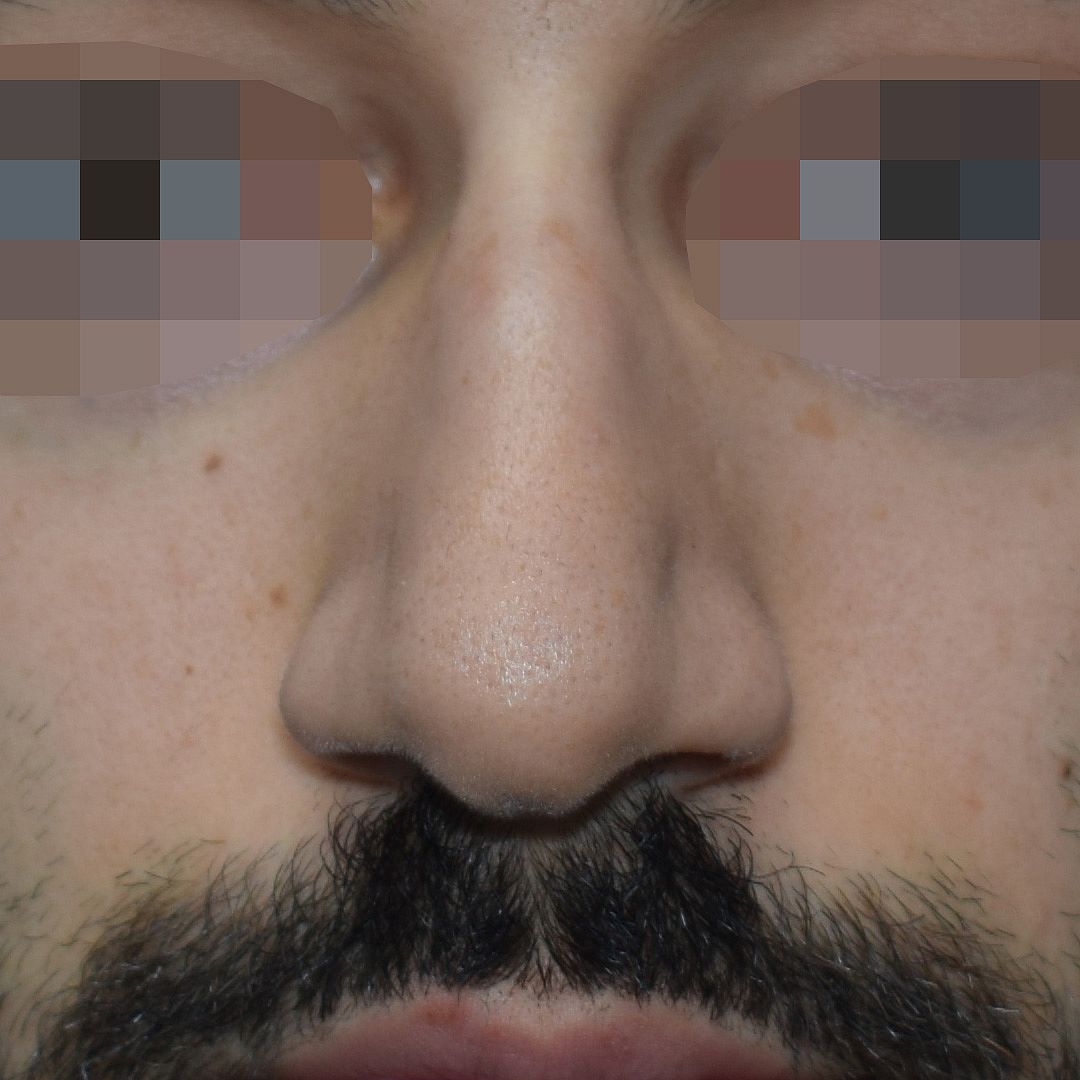 Nasenkorrektur, 28 Vorher Nachher
