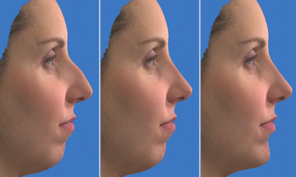 3D Simulation der Nasenkorrektur